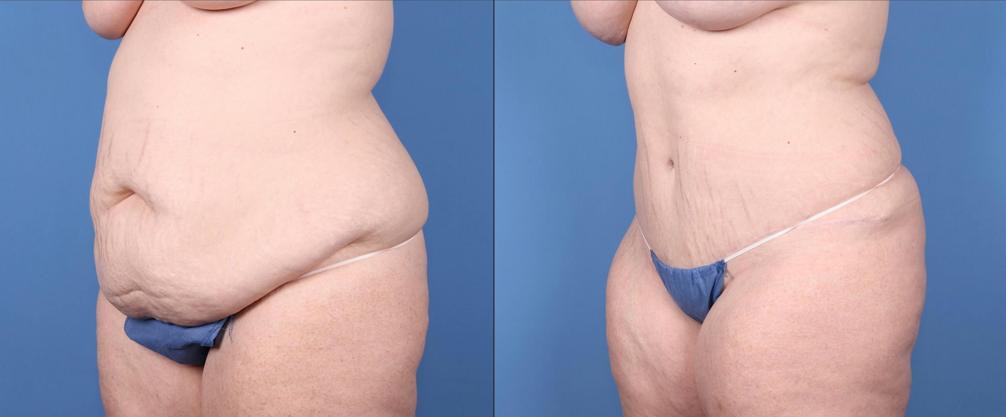 Tummy Tuck Before & After Gallery - Patient 147103896 - Image 4