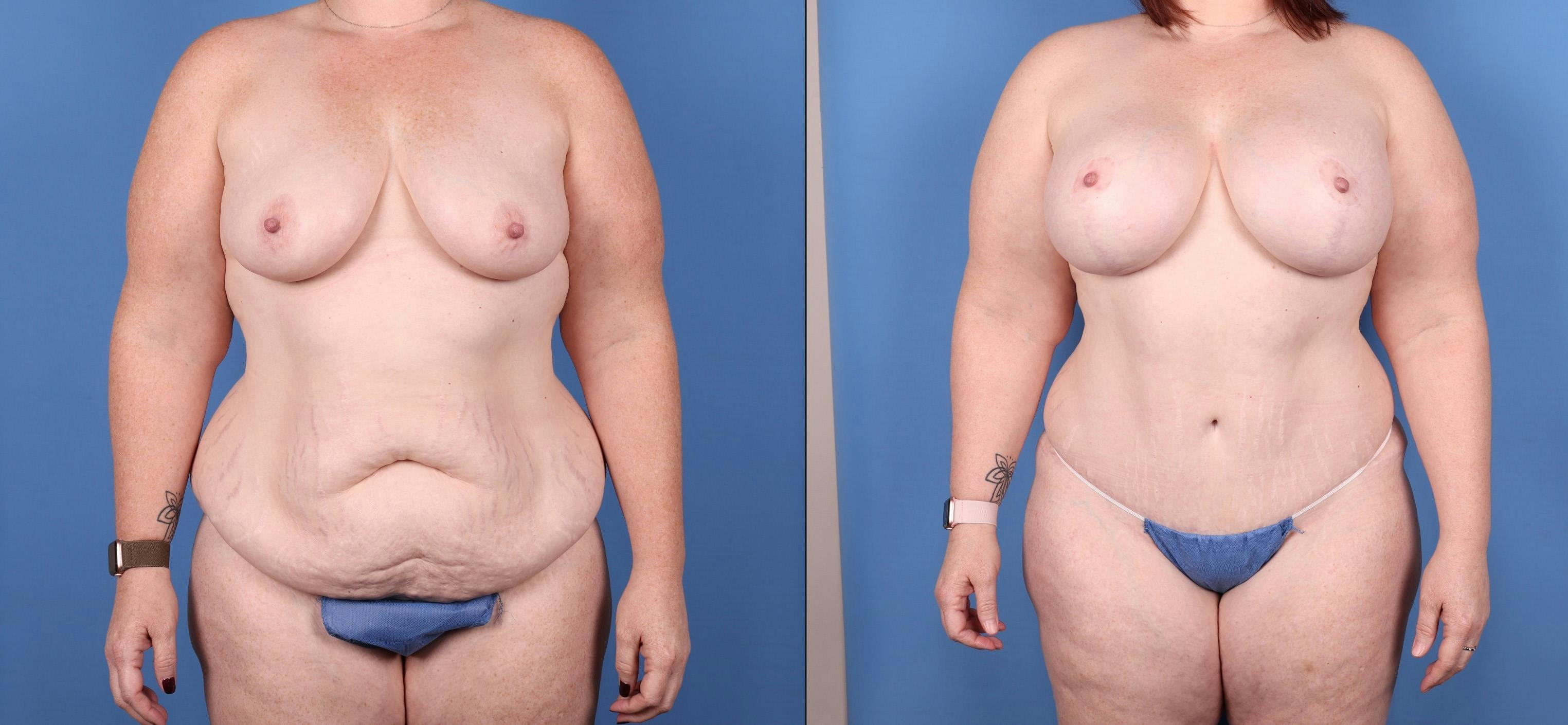 Mommy Makeover Before & After Gallery - Patient 147103879 - Image 1