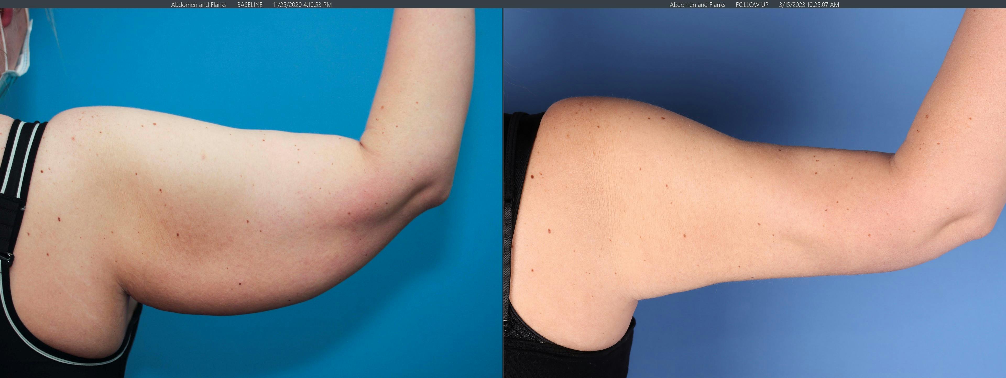 Arm Lift Before & After Gallery - Patient 147103937 - Image 1