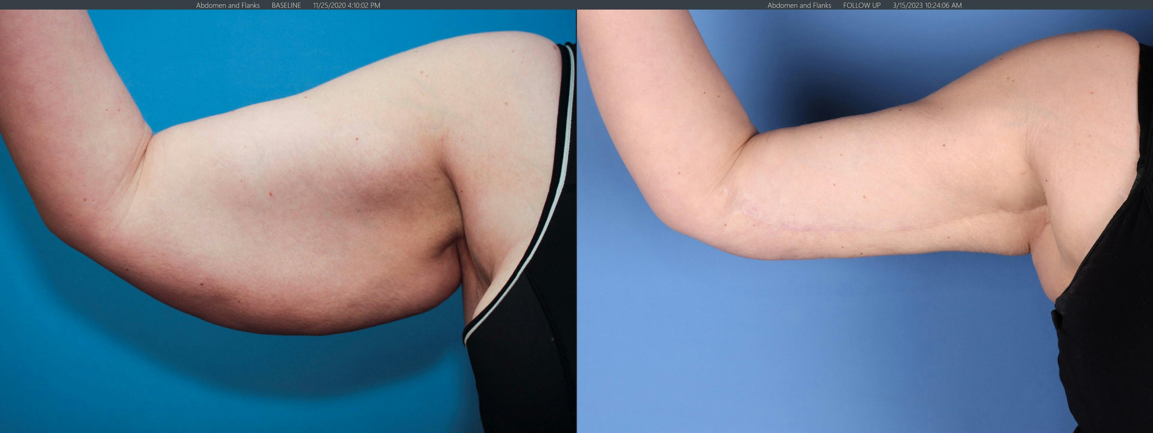 Arm Lift Before & After Gallery - Patient 368358 - Image 3