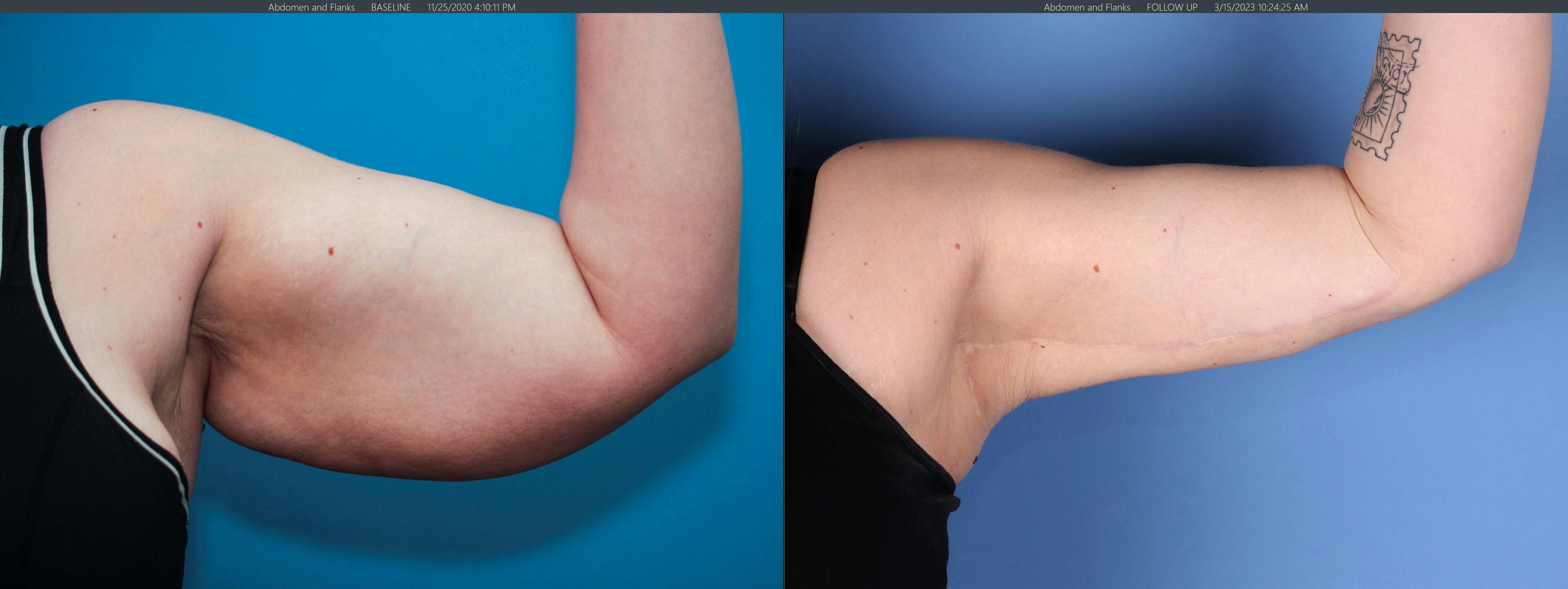 Arm Lift Before & After Gallery - Patient 368358 - Image 2
