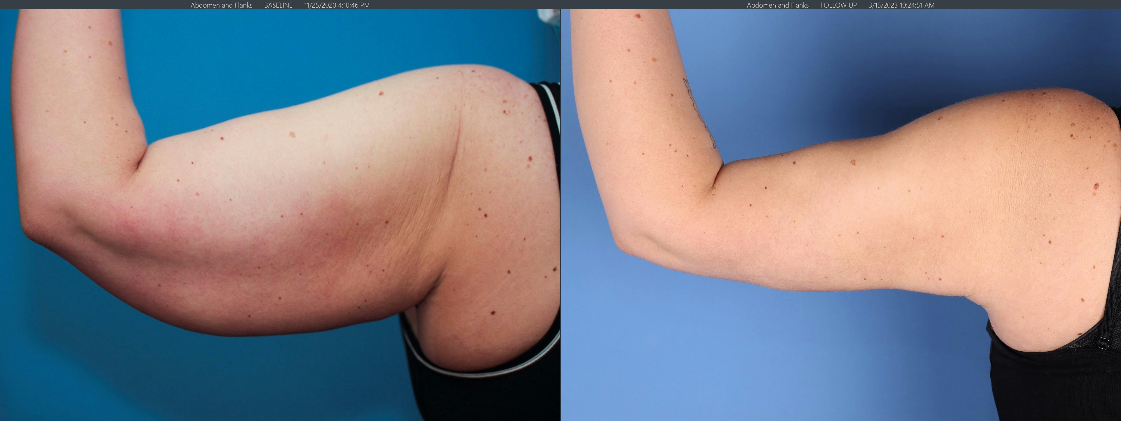 Arm Lift Before & After Gallery - Patient 368358 - Image 4