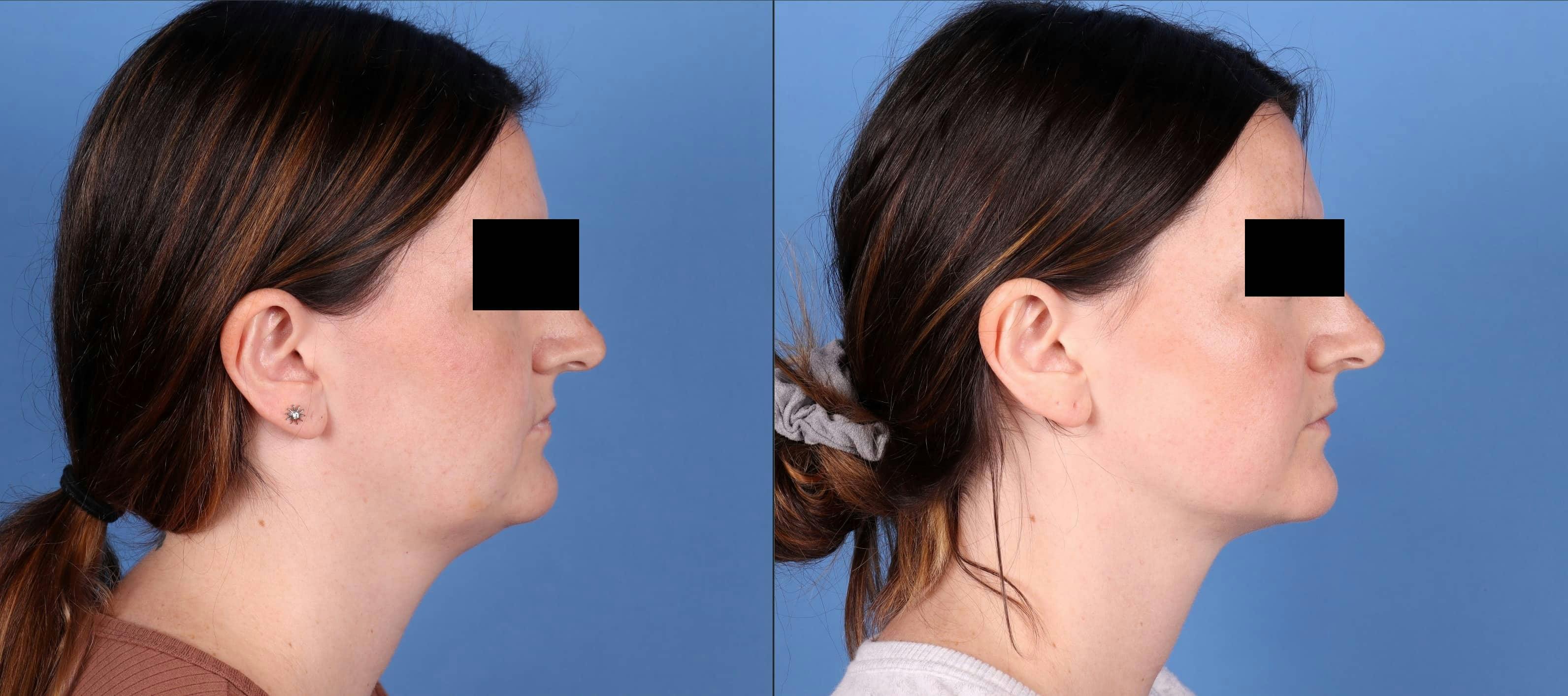 Liposuction Before & After Gallery - Patient 147120306 - Image 3