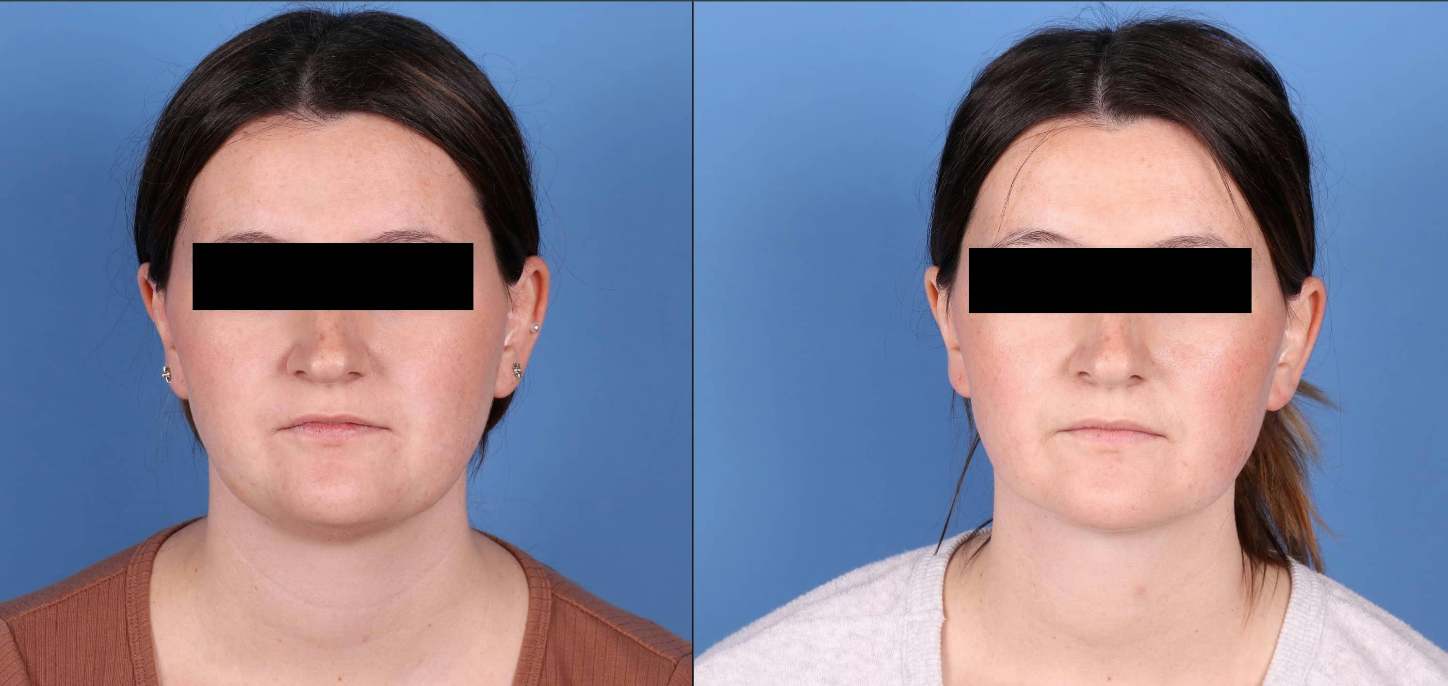 Face & Neck Before & After Gallery - Patient 149385106 - Image 1