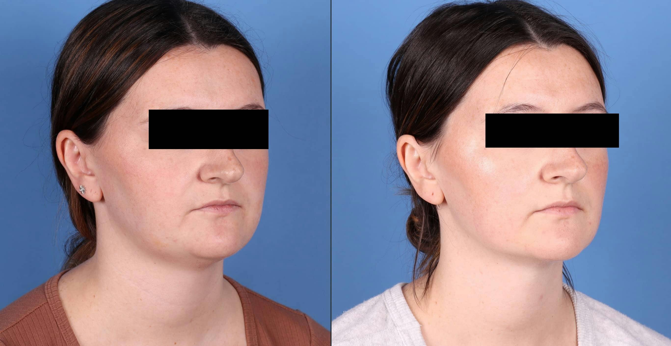 Face & Neck Before & After Gallery - Patient 149385106 - Image 2