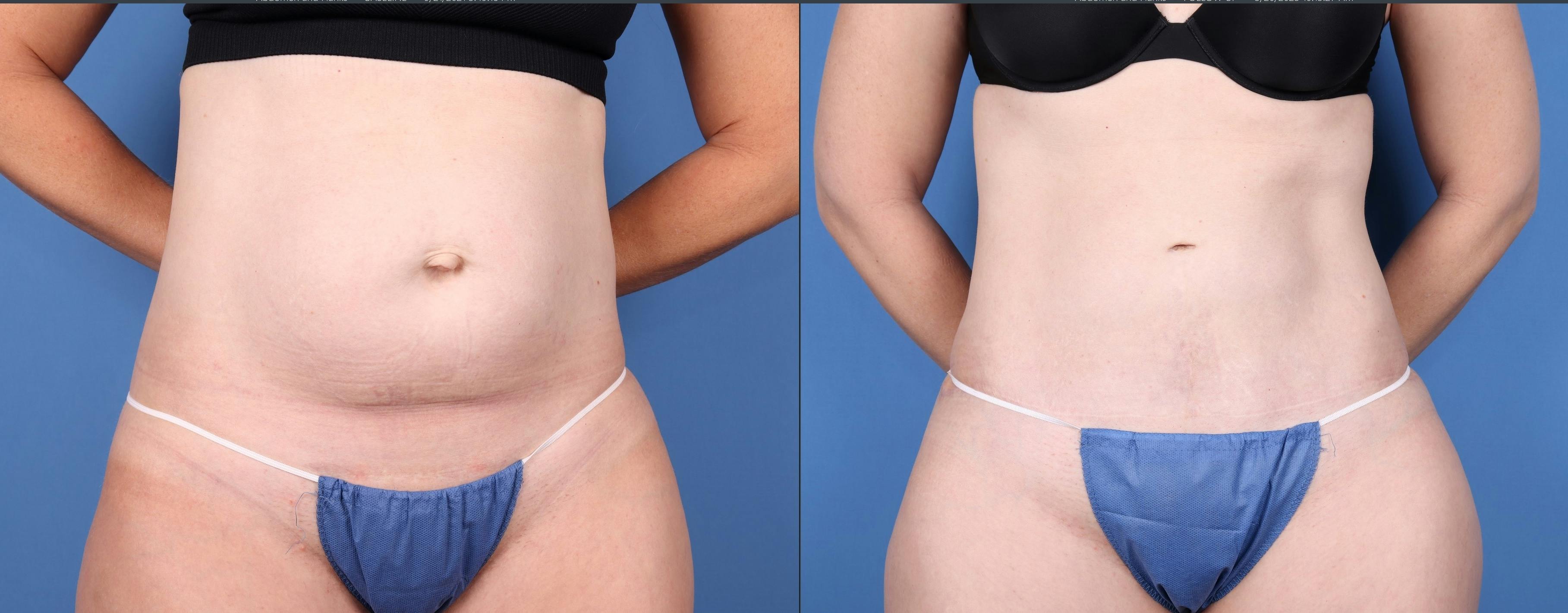 Tummy Tuck Before & After Gallery - Patient 147417079 - Image 1