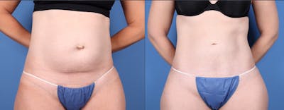 Tummy Tuck Before & After Gallery - Patient 147417079 - Image 1