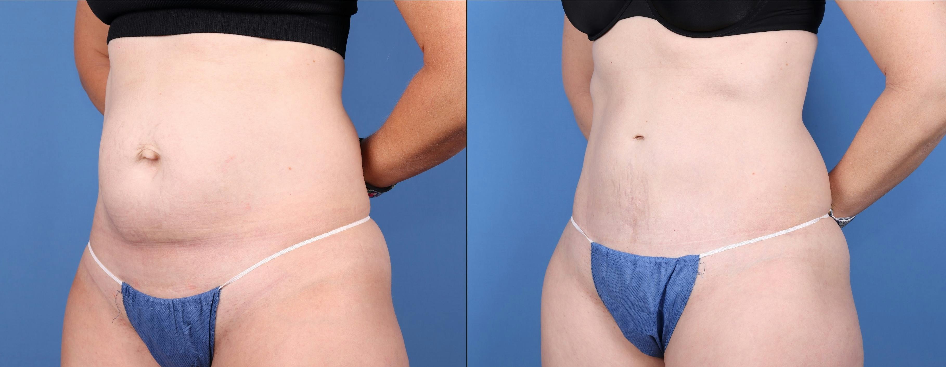 Liposuction Before & After Gallery - Patient 147417078 - Image 2