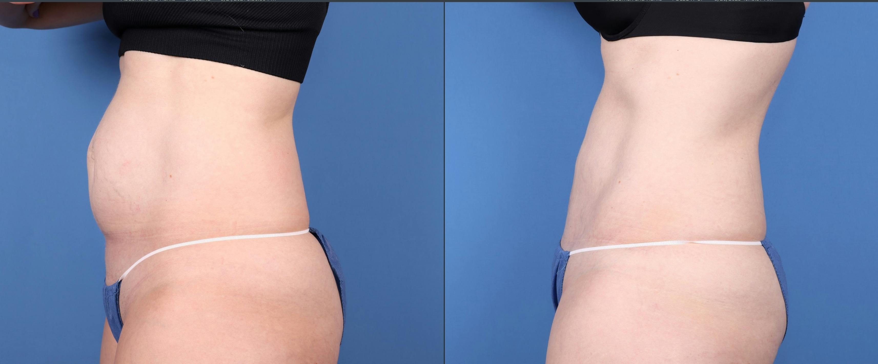 Tummy Tuck Before & After Gallery - Patient 147417079 - Image 3