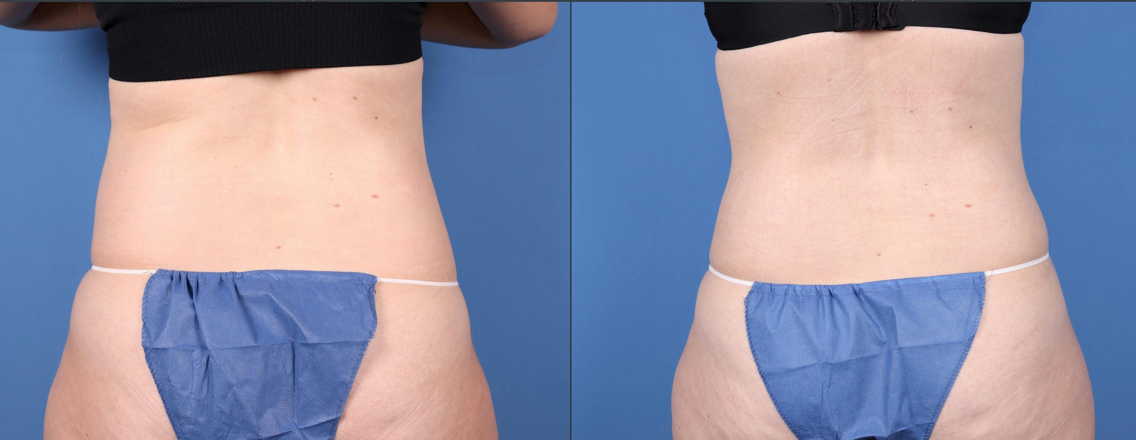 Tummy Tuck Before & After Gallery - Patient 147417079 - Image 4