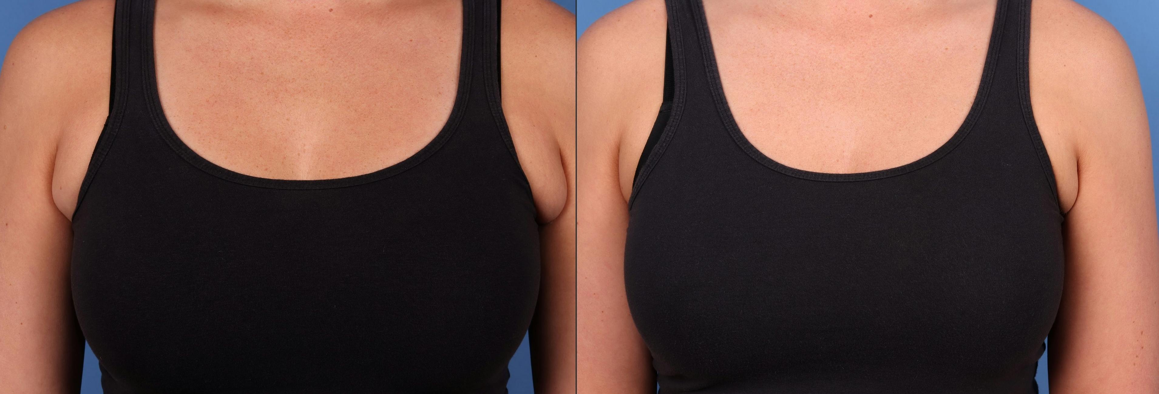 Arms Before & After Gallery - Patient 147418231 - Image 1