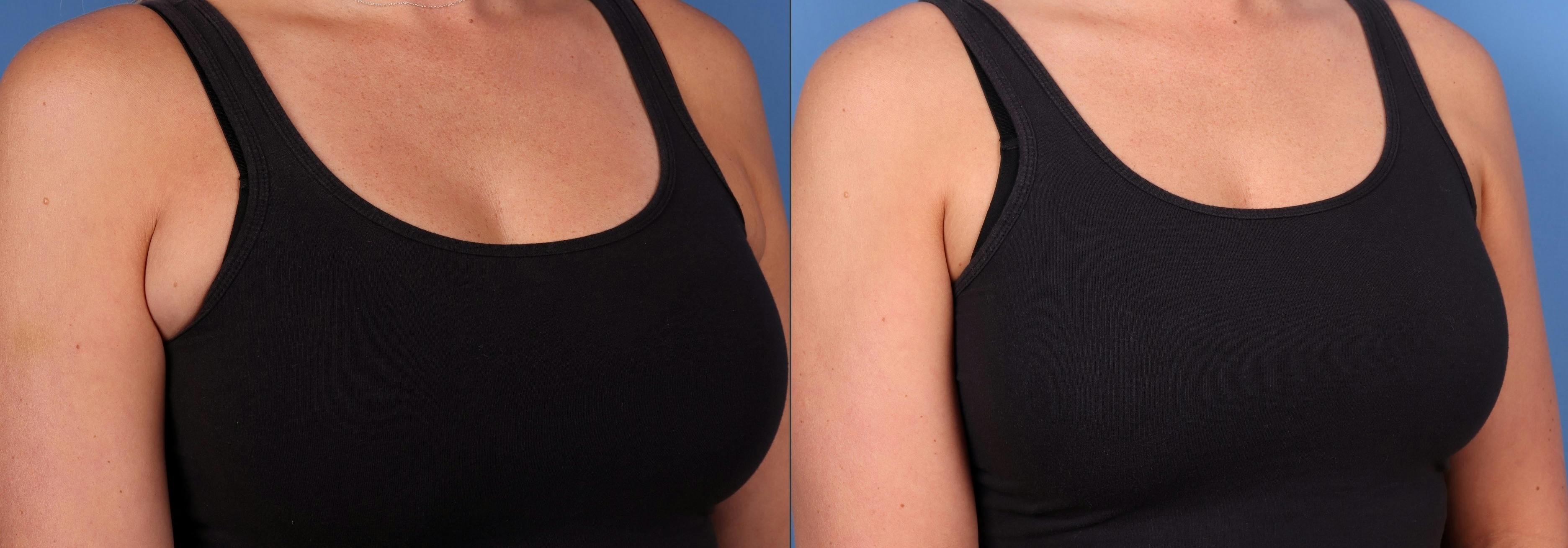 Arms Before & After Gallery - Patient 147418231 - Image 3