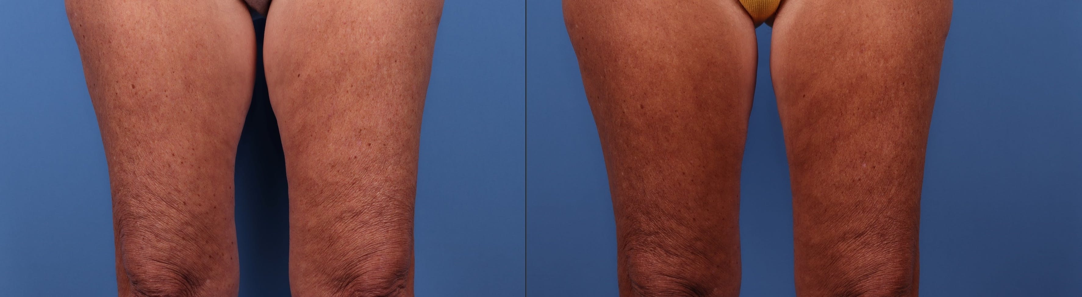 Thighs Before & After Gallery - Patient 147418275 - Image 2