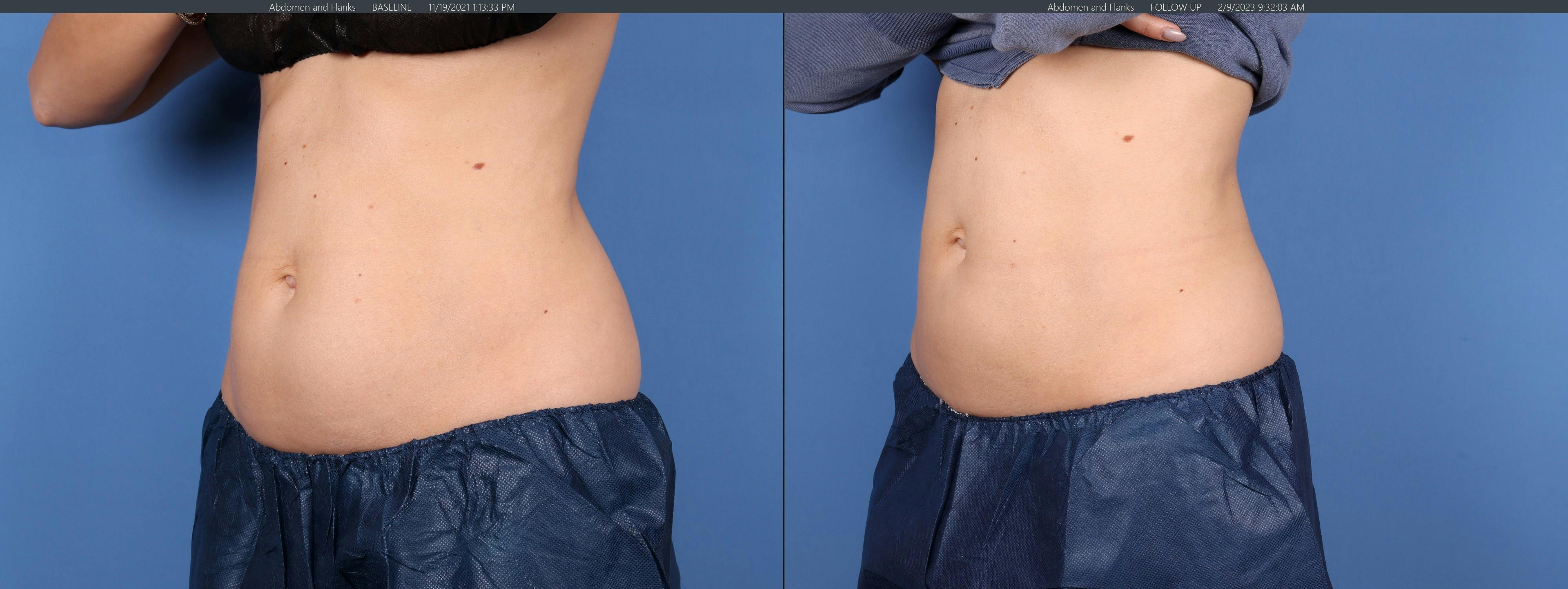 Body Before & After Gallery - Patient 147418466 - Image 2
