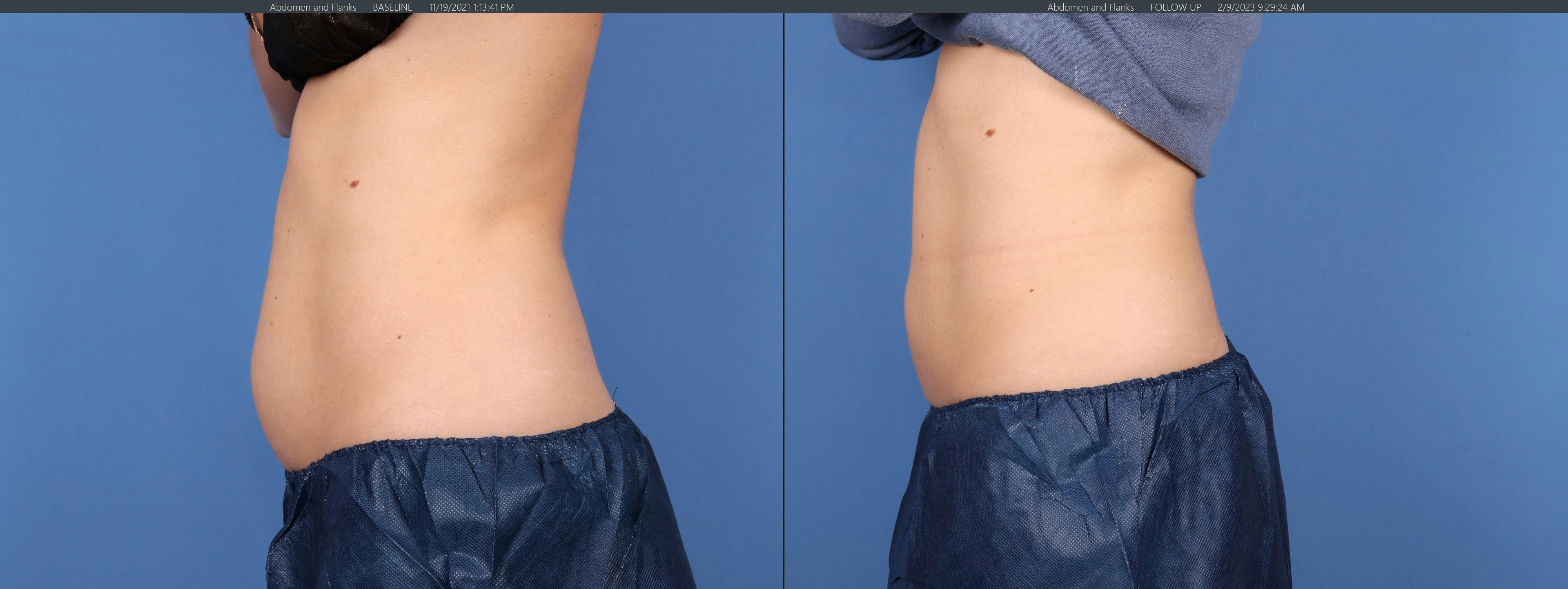 Body Before & After Gallery - Patient 147418466 - Image 3
