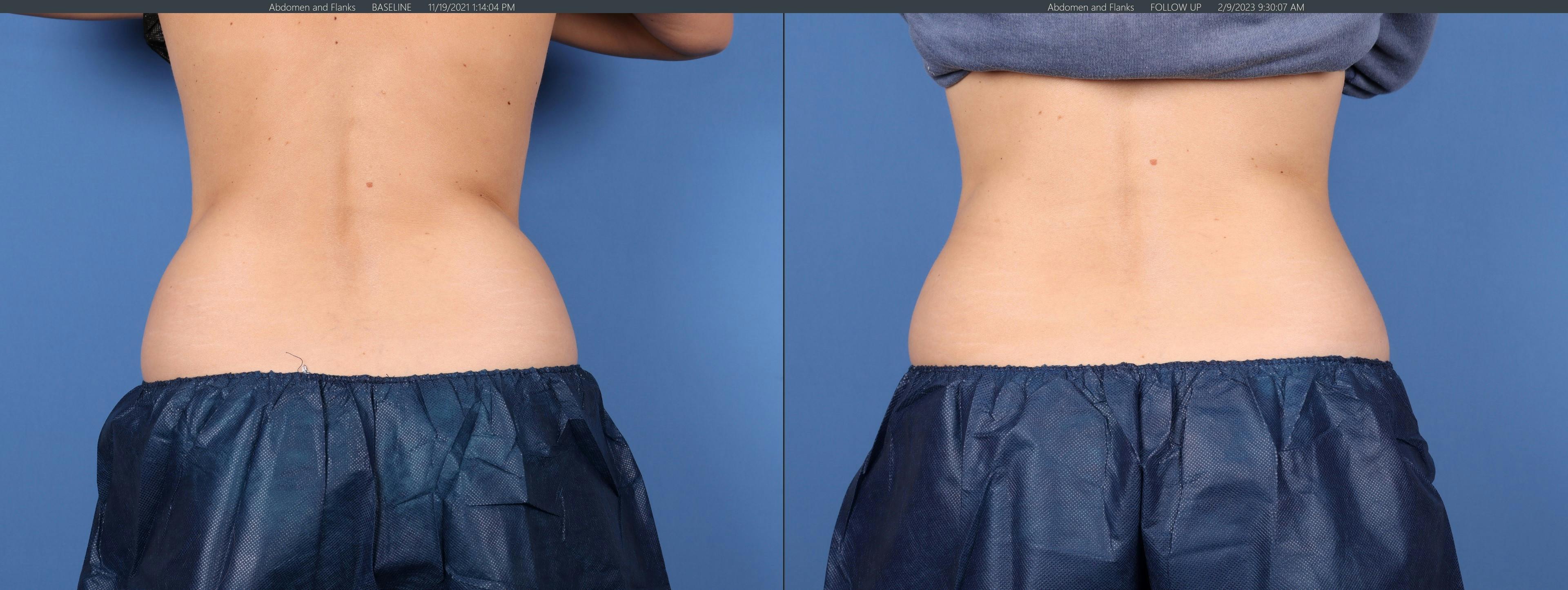 Body Before & After Gallery - Patient 147418466 - Image 4