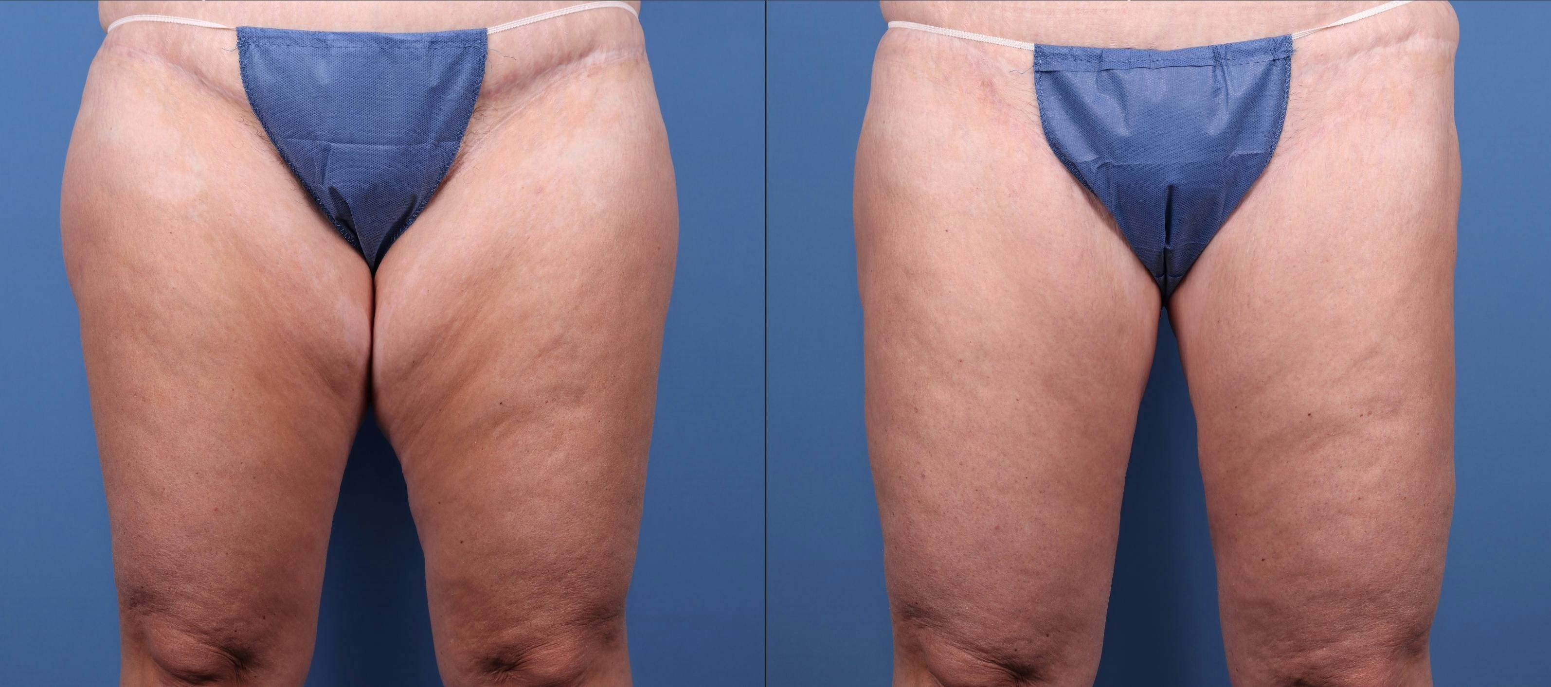 Thigh Lift Before & After Gallery - Patient 147580593 - Image 1