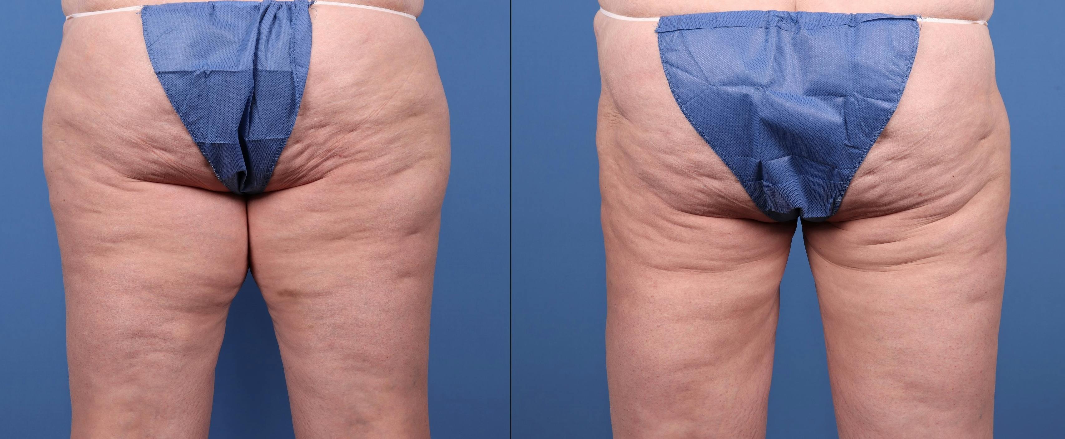 Thigh Lift Before & After Gallery - Patient 147580593 - Image 2