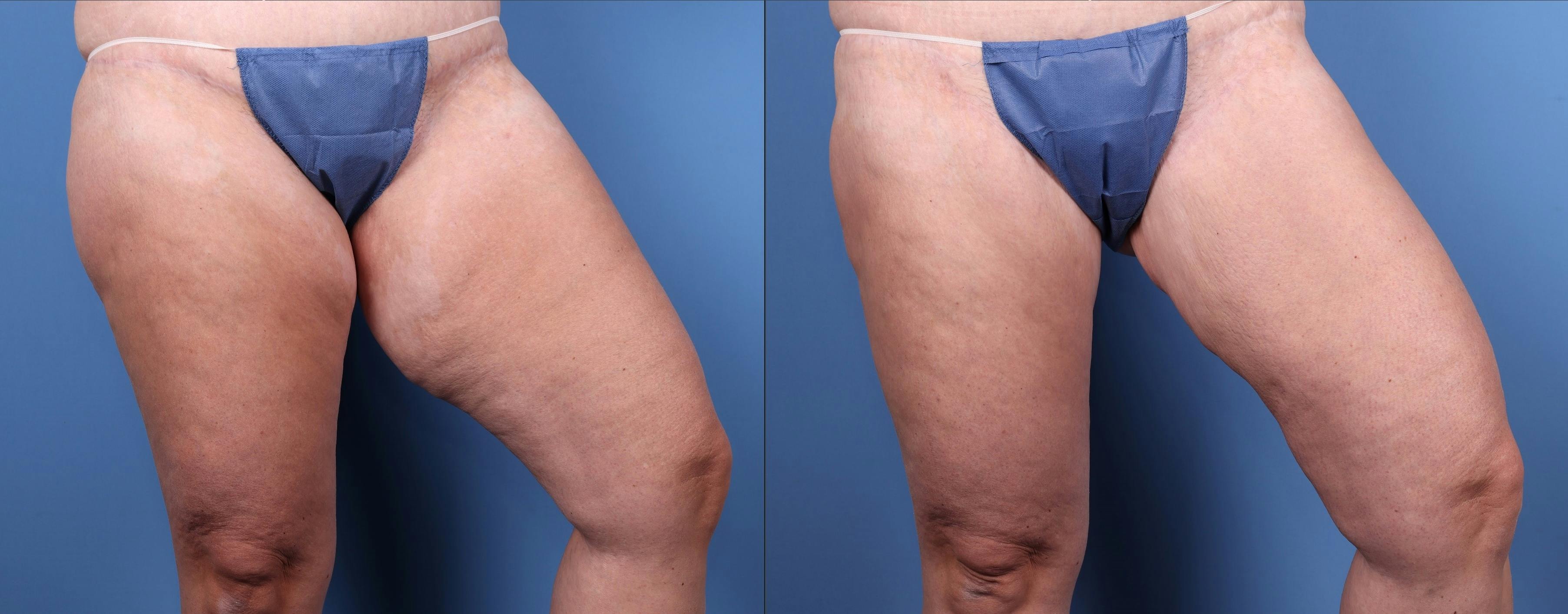 Thigh Lift Before & After Gallery - Patient 147580593 - Image 3