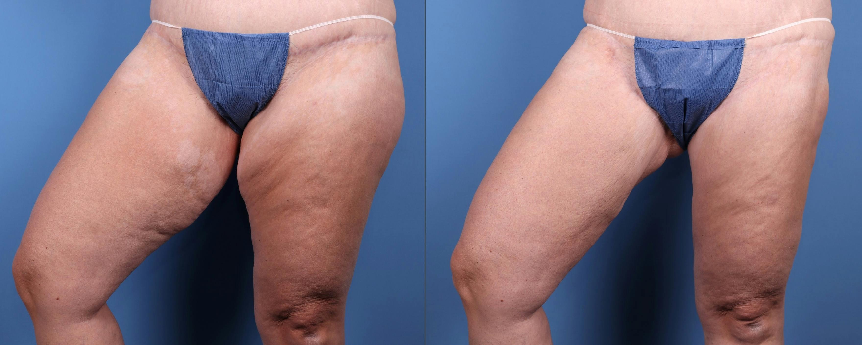 Thigh Lift Before & After Gallery - Patient 147580593 - Image 4