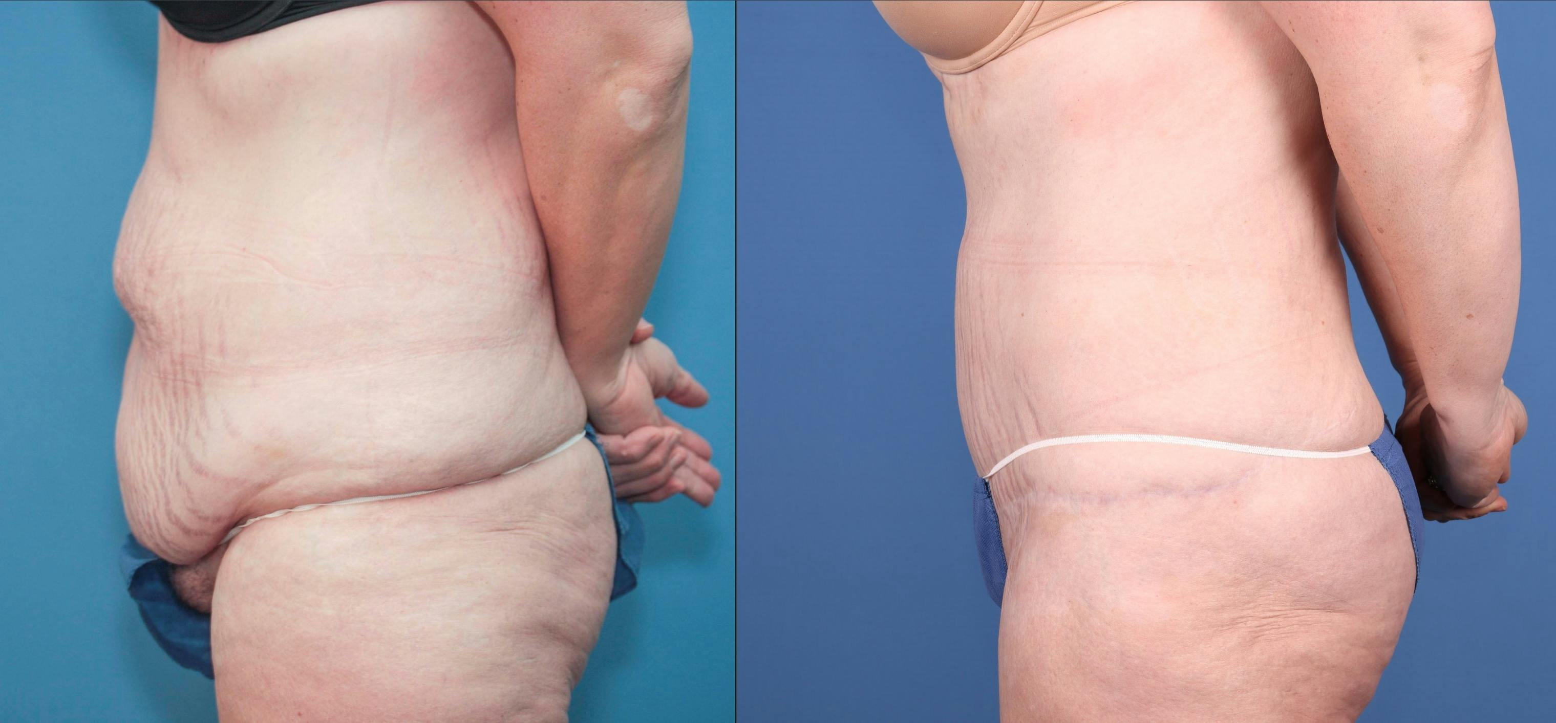 Abdomen Before & After Gallery - Patient 149385207 - Image 2