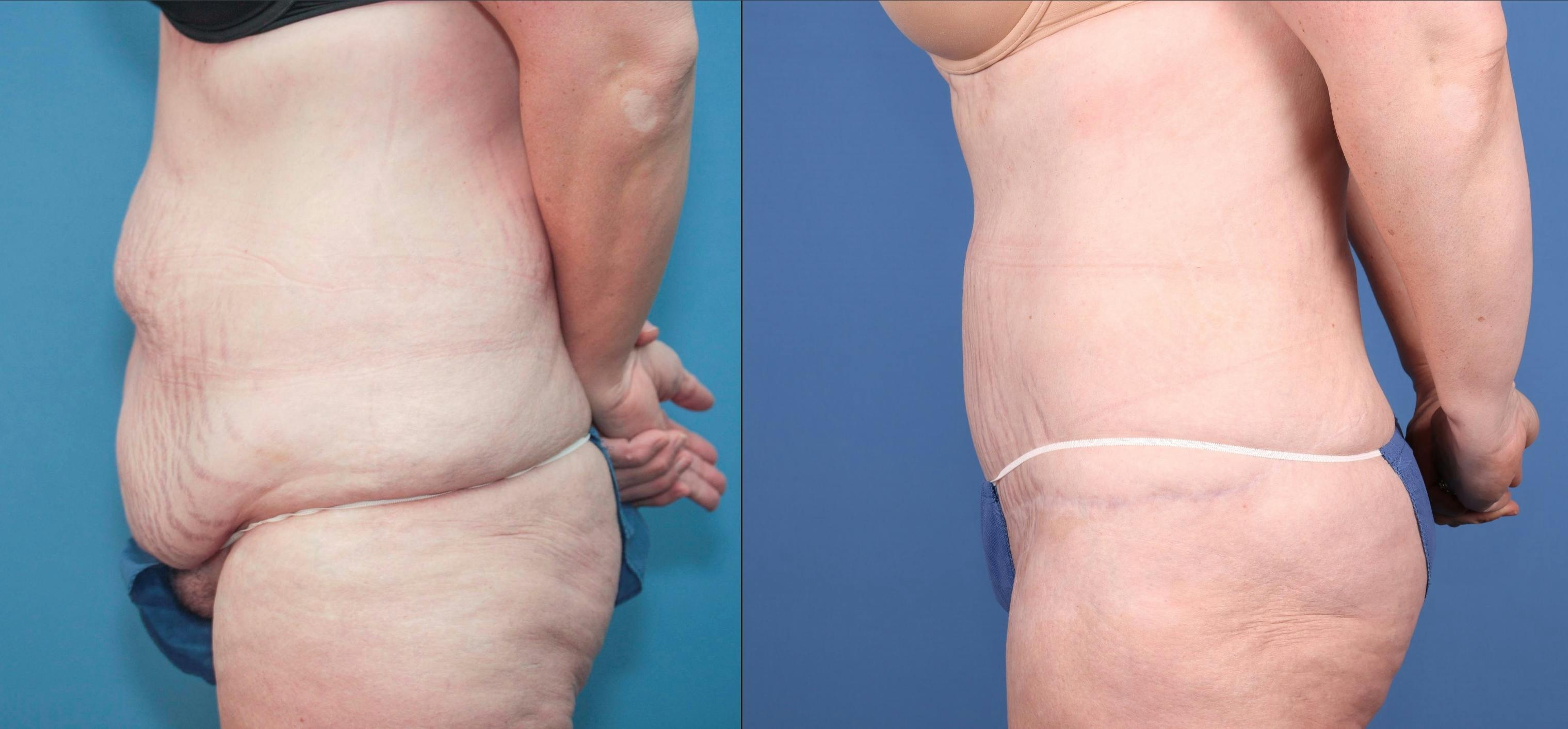 Tummy Tuck Before & After Gallery - Patient 147580601 - Image 2