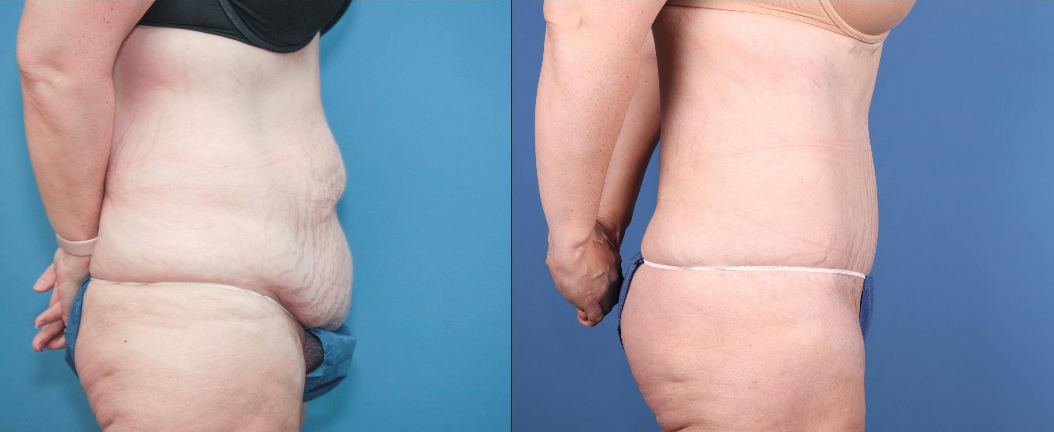 Tummy Tuck Before & After Gallery - Patient 147580601 - Image 3