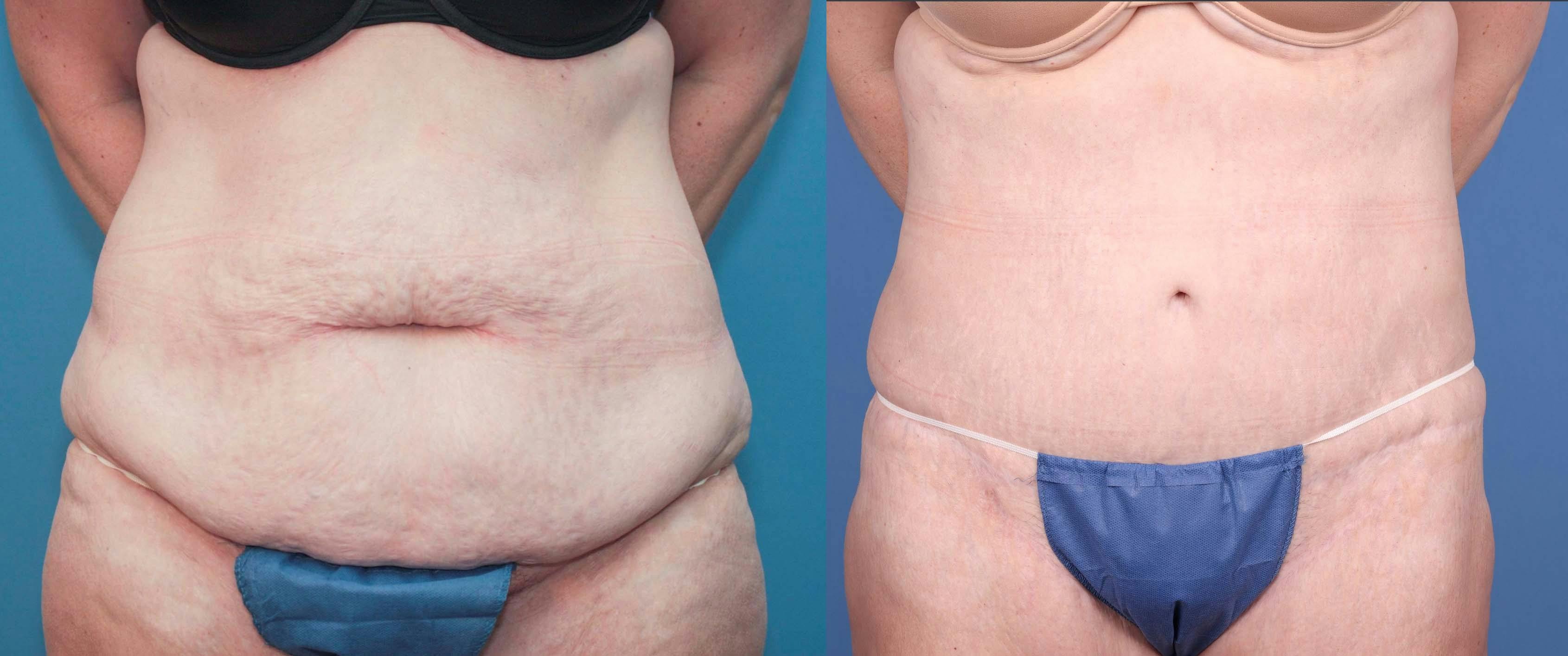 Tummy Tuck Before & After Gallery - Patient 147580601 - Image 1