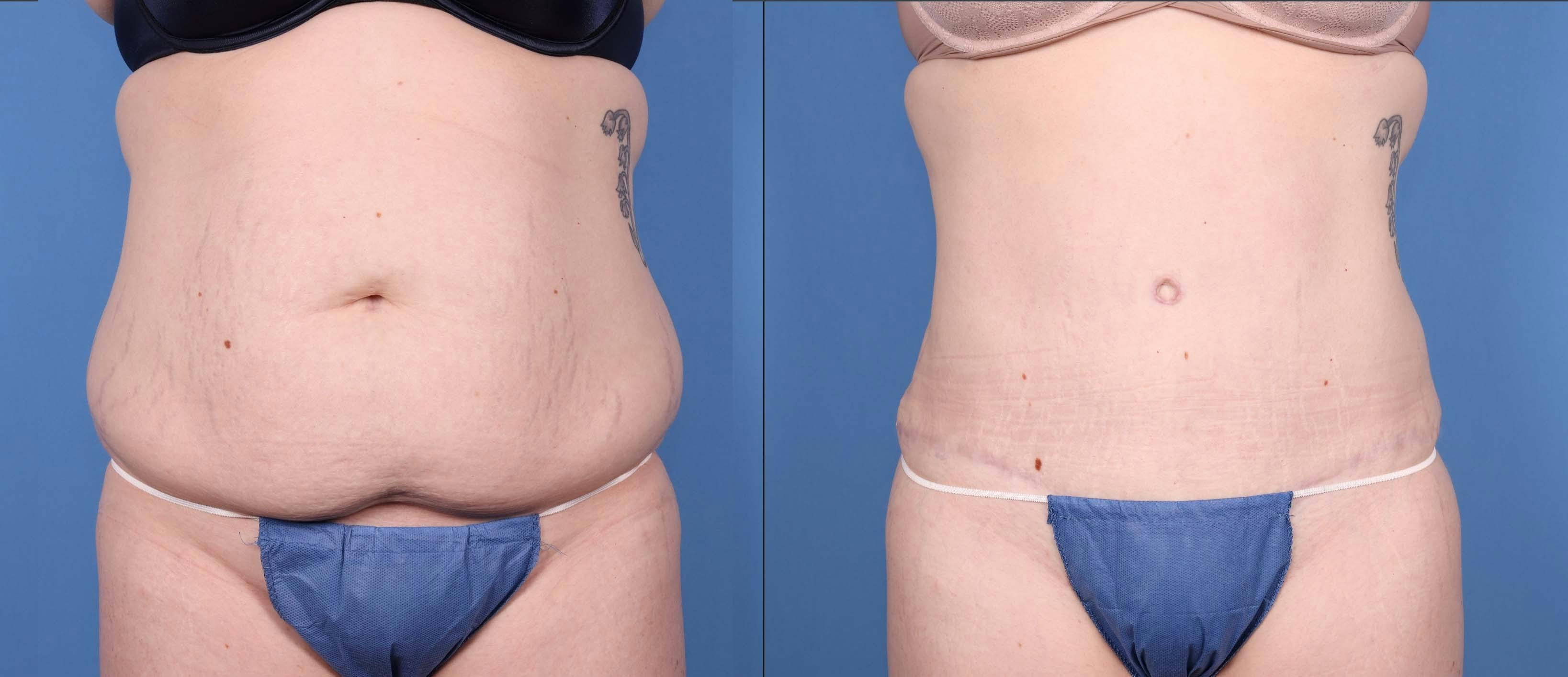 Abdomen Before & After Gallery - Patient 149385206 - Image 1