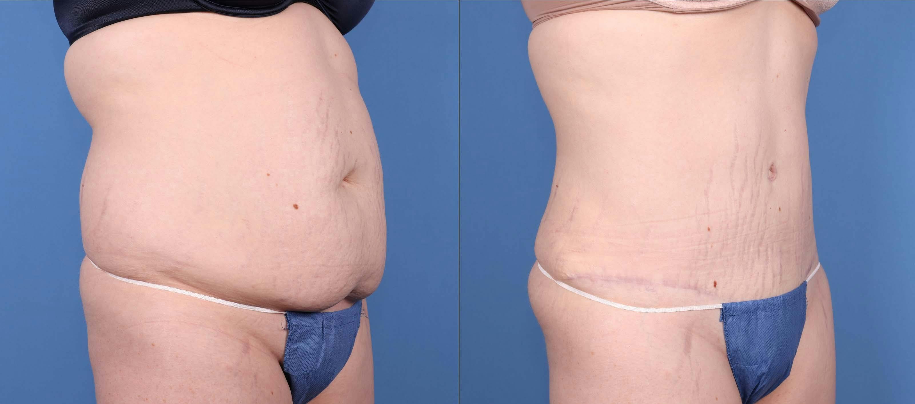 Liposuction Before & After Gallery - Patient 147694981 - Image 2