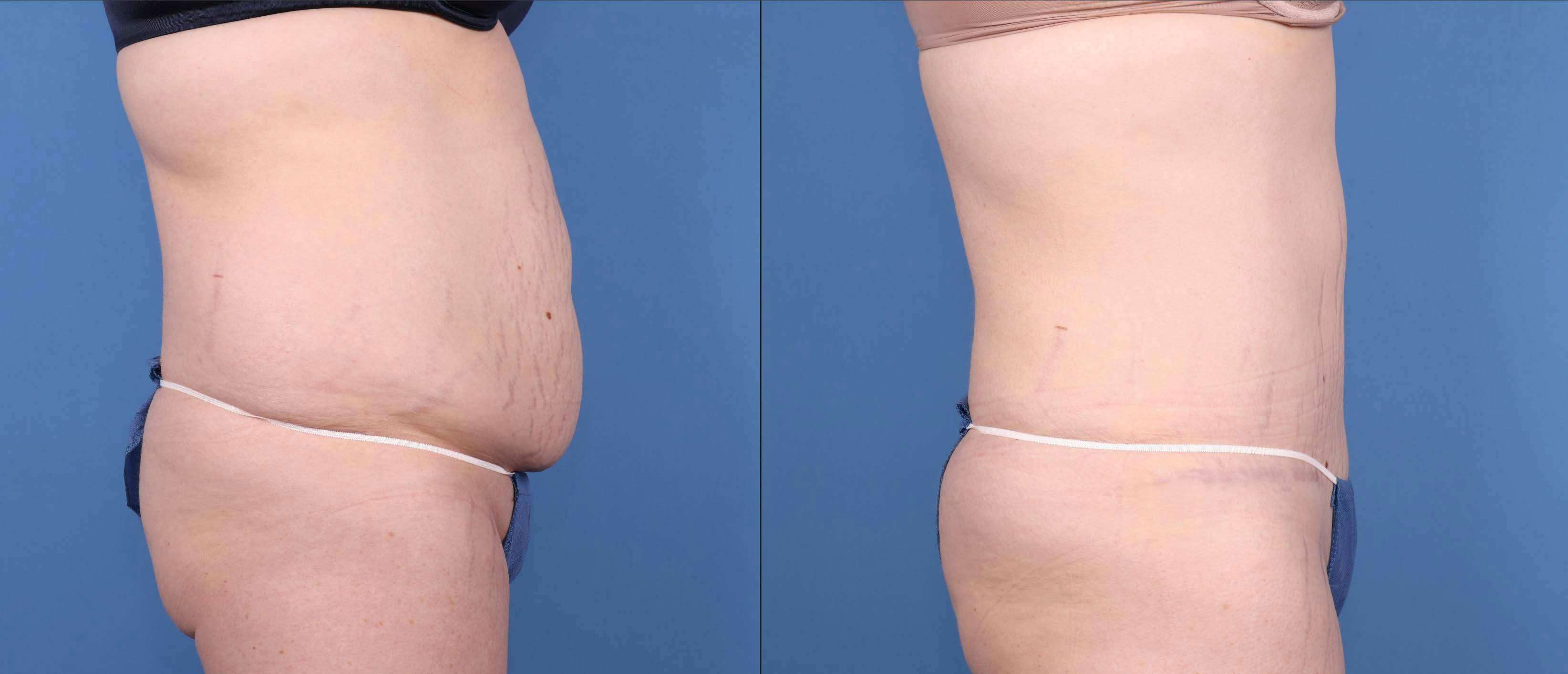 Abdomen Before & After Gallery - Patient 149385206 - Image 3