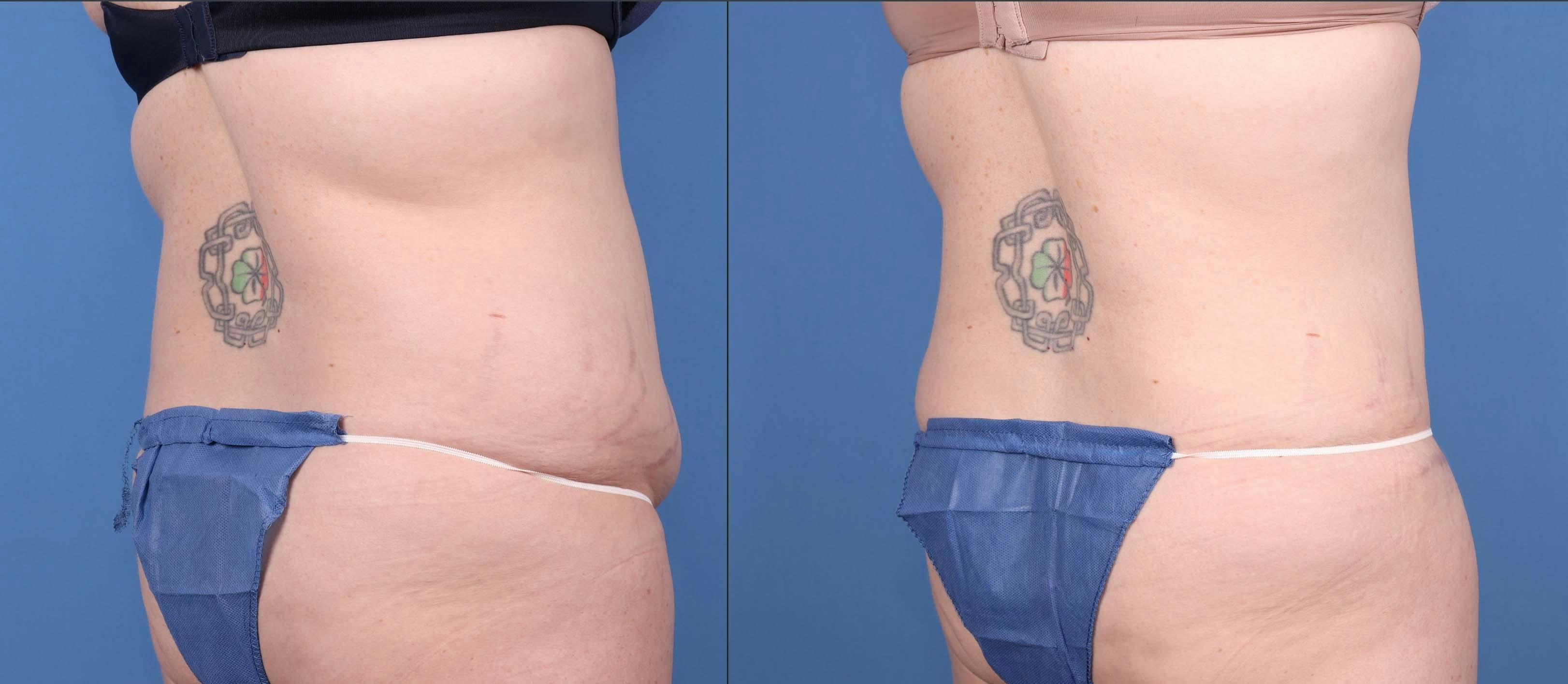 Abdomen Before & After Gallery - Patient 149385206 - Image 4
