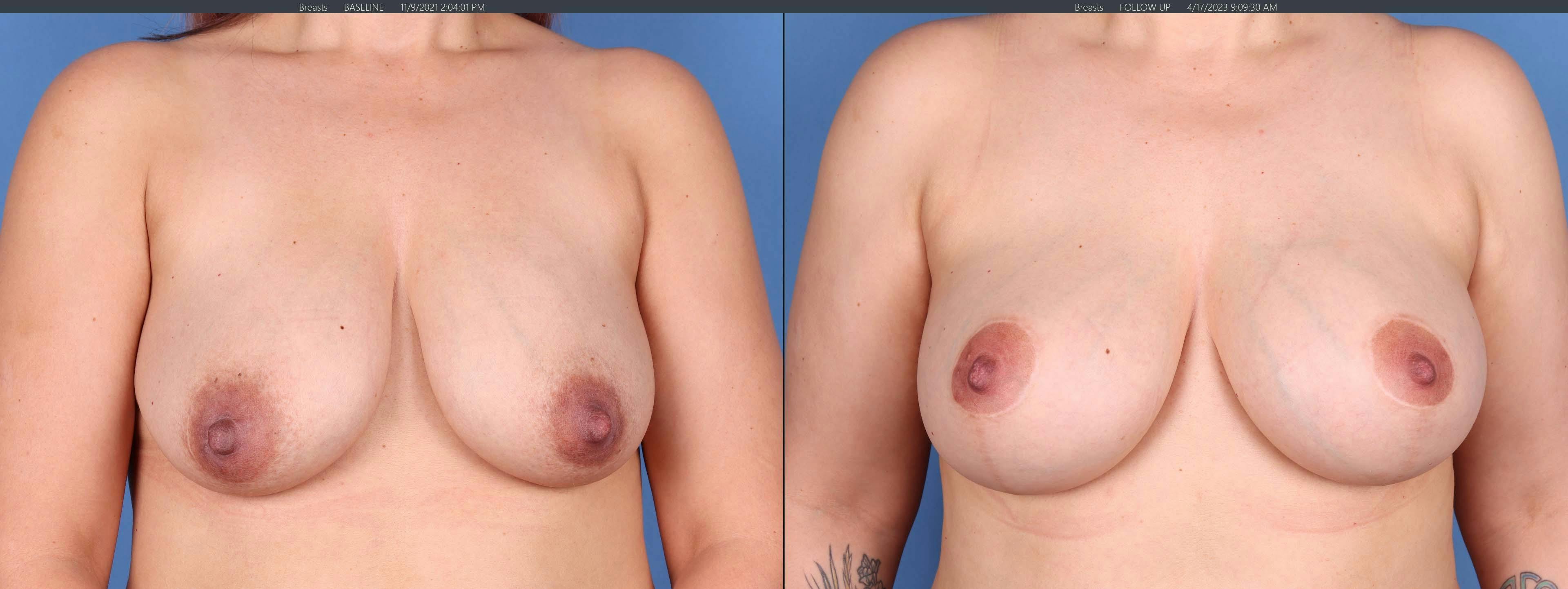Breast Lift Before & After Gallery - Patient 148100834 - Image 1