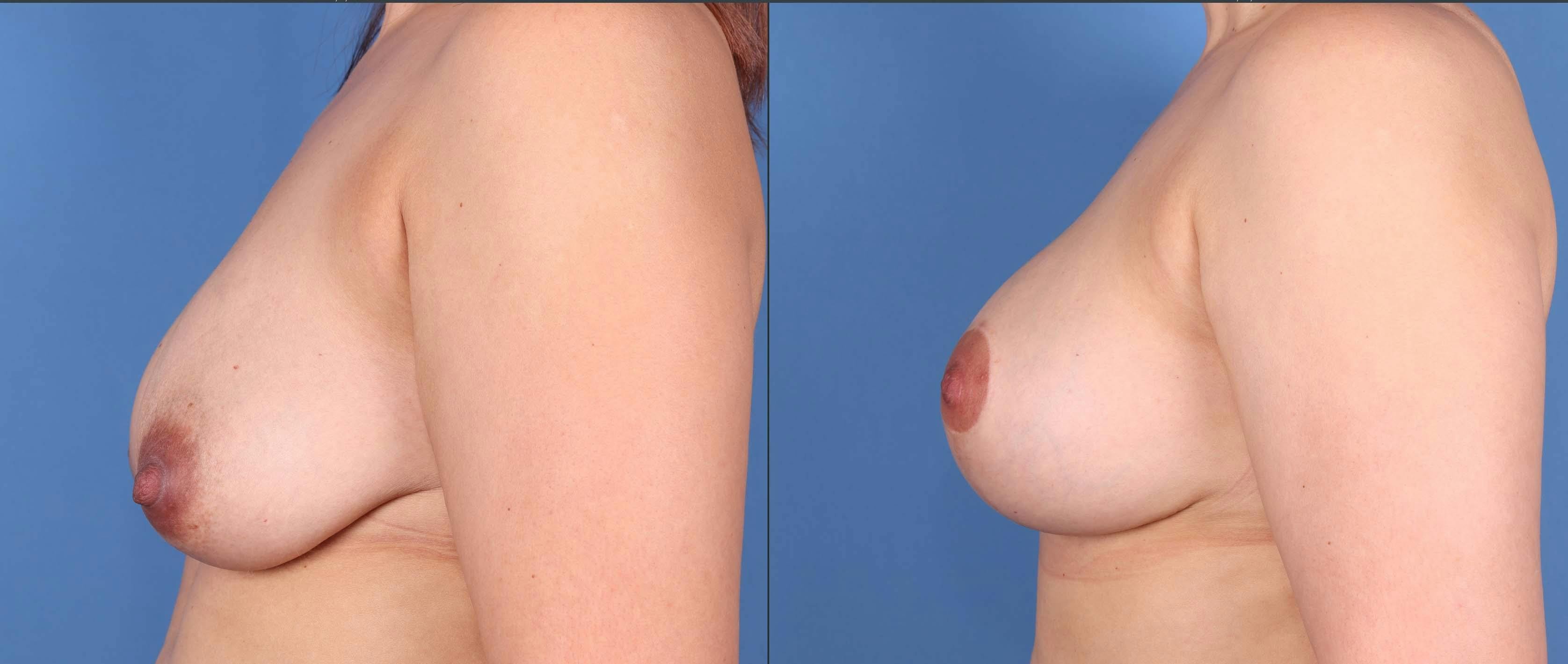 Breast Lift Before & After Gallery - Patient 148100834 - Image 3
