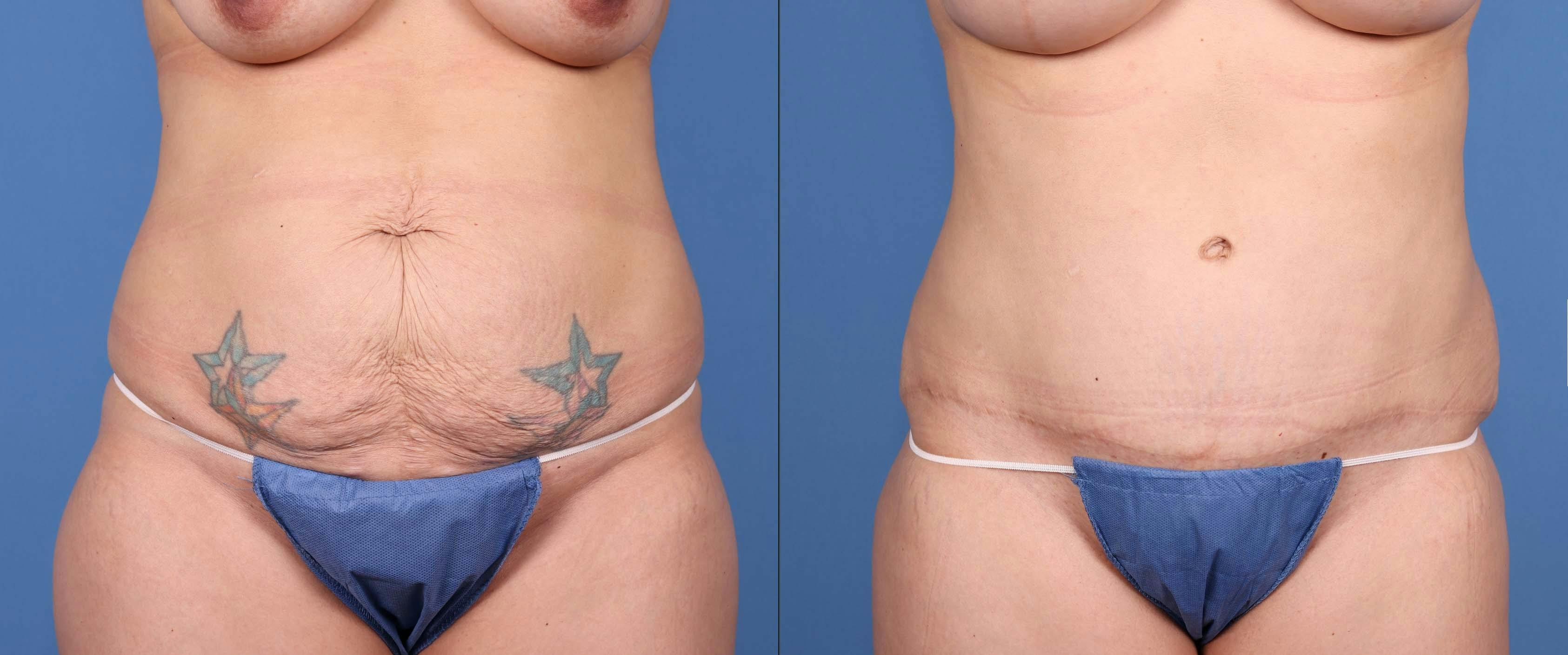 Tummy Tuck Before & After Gallery - Patient 148100836 - Image 1