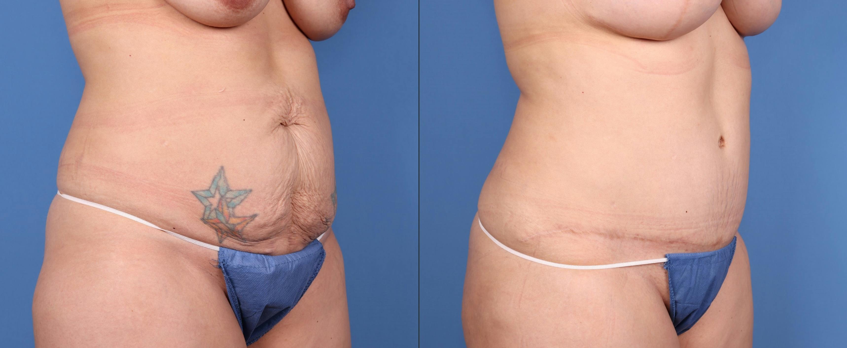Tummy Tuck Before & After Gallery - Patient 148100836 - Image 2
