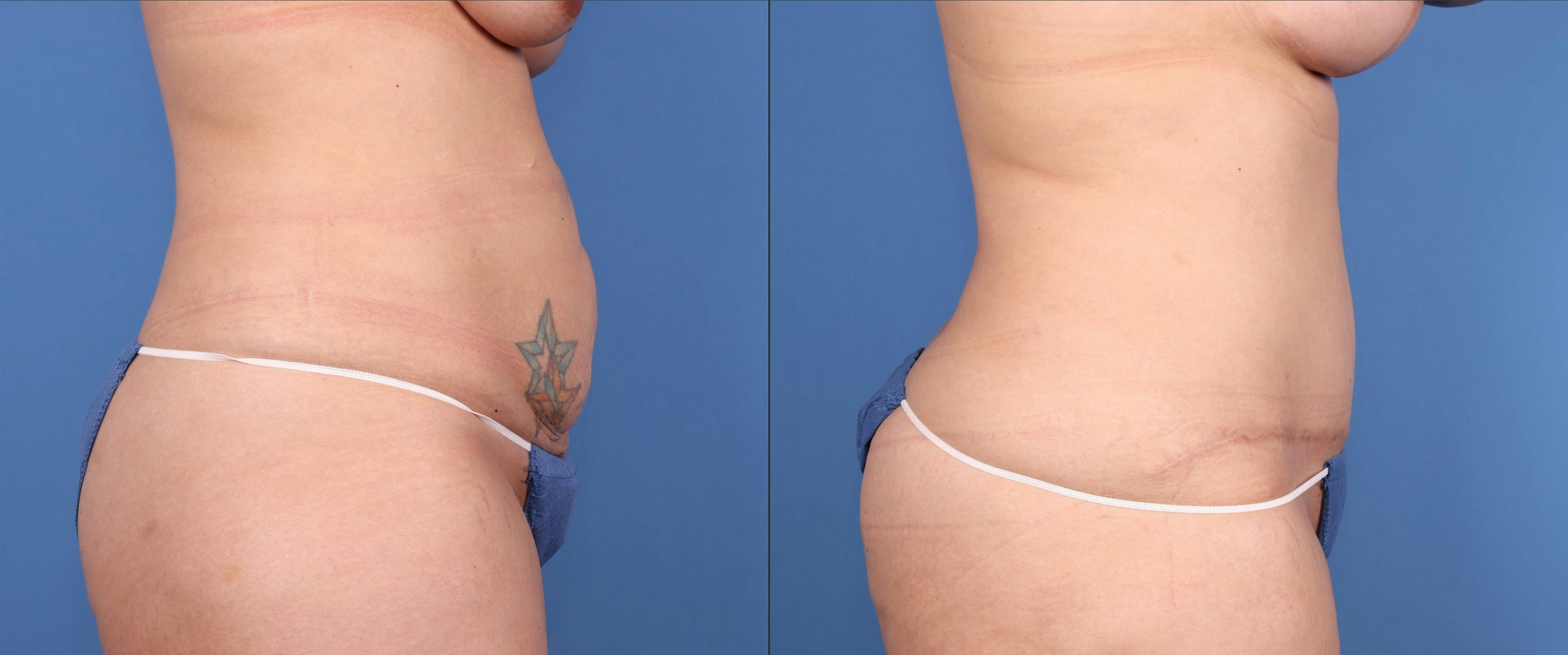 Tummy Tuck Before & After Gallery - Patient 148100836 - Image 3