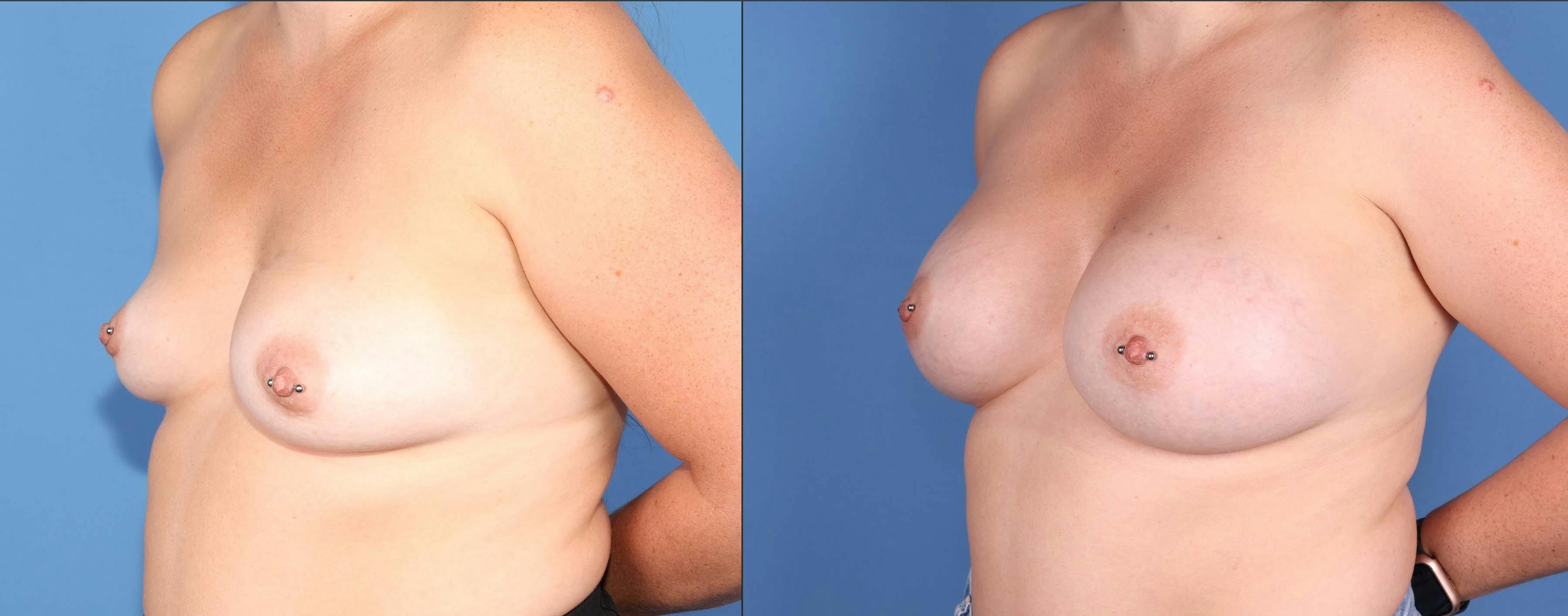 Breast Augmentation Before & After Gallery - Patient 148101167 - Image 2
