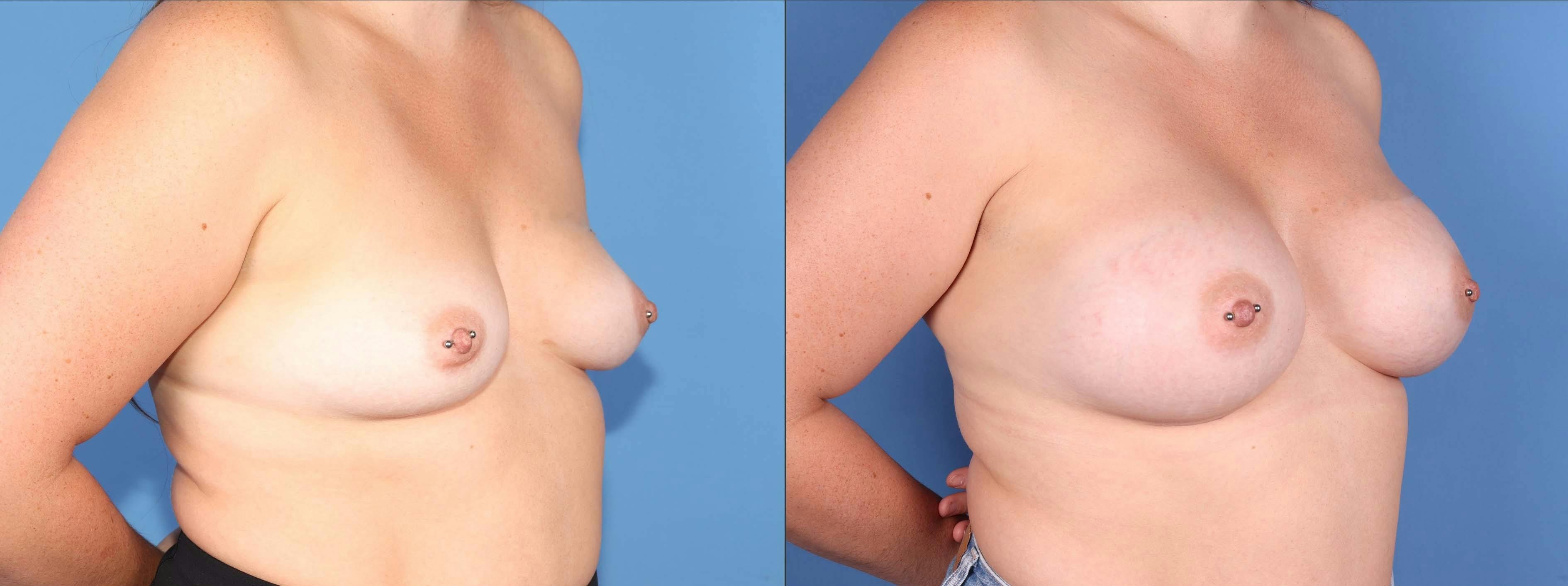 Breast Augmentation Before & After Gallery - Patient 148101167 - Image 4