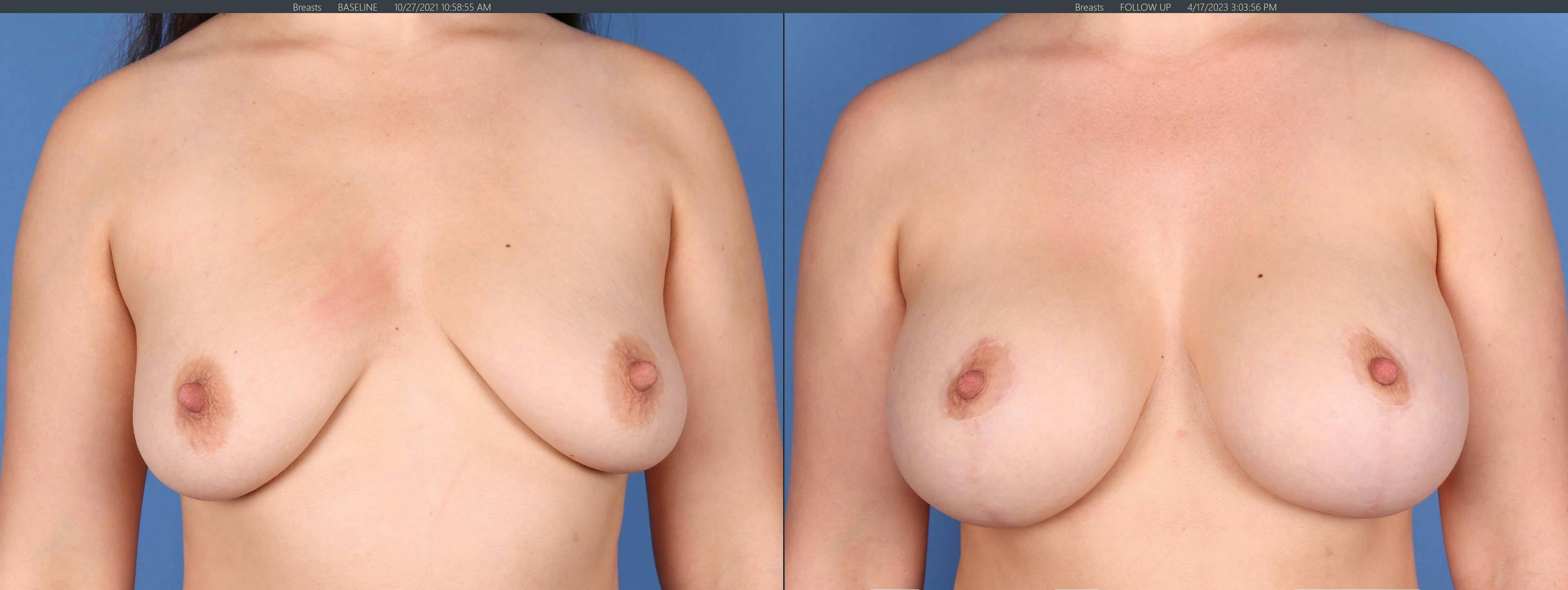 Breast Lift with Augmentation Before & After Gallery - Patient 148128905 - Image 1
