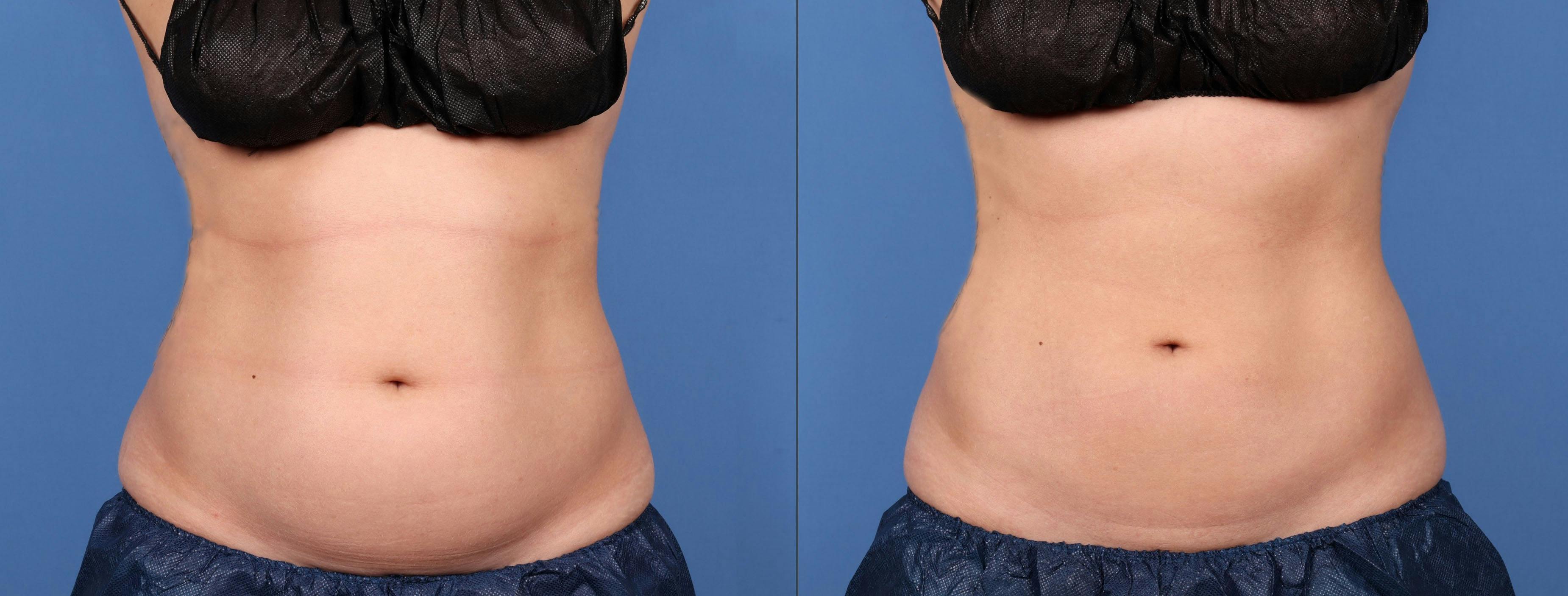 Body Before & After Gallery - Patient 148394096 - Image 1