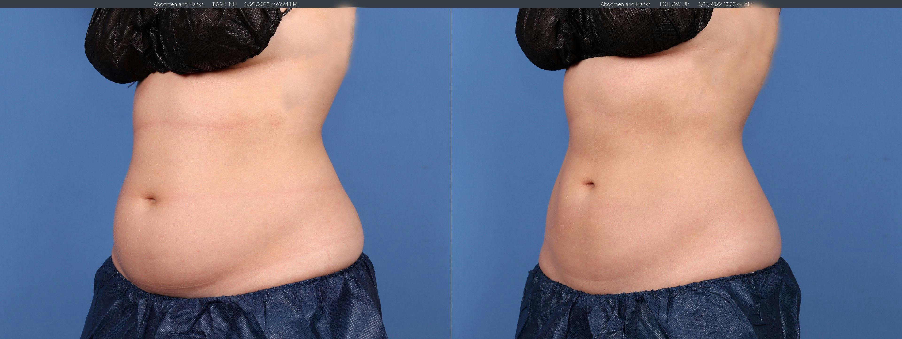 Body Before & After Gallery - Patient 148394096 - Image 2