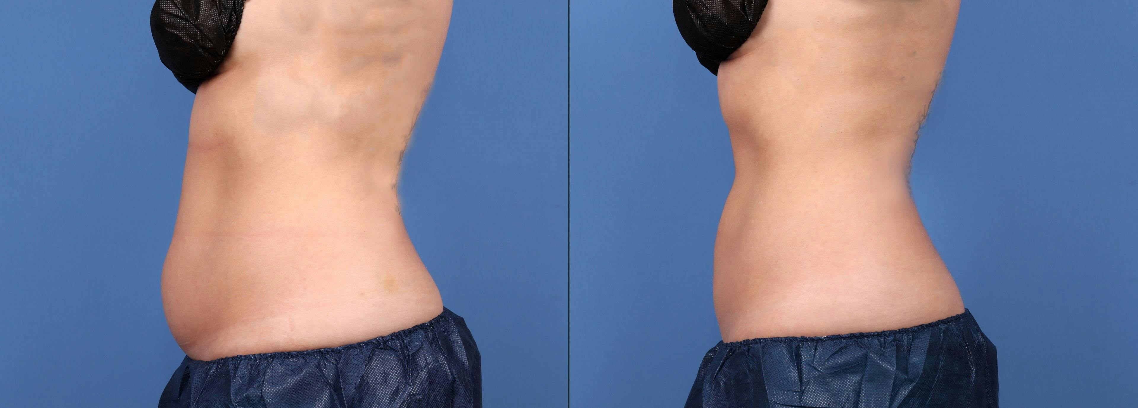 Body Before & After Gallery - Patient 148394096 - Image 3