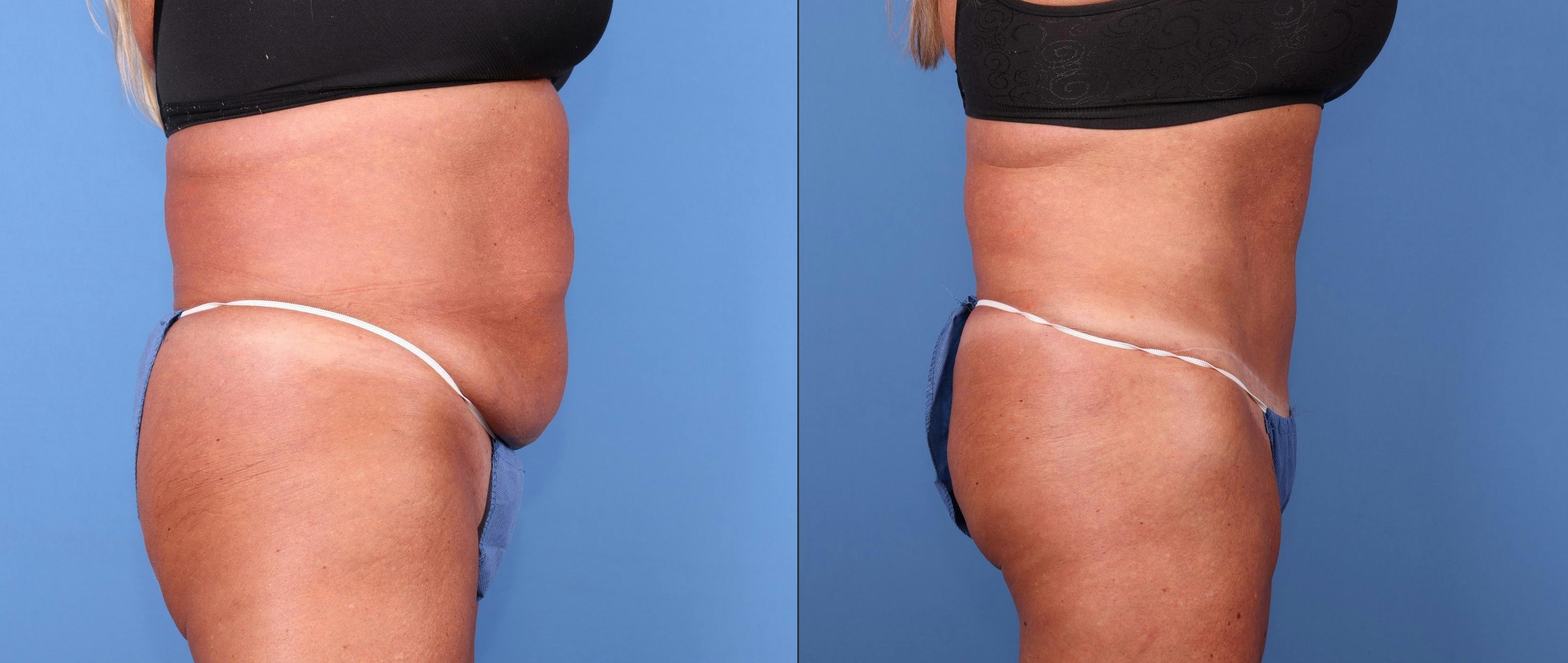 Abdomen Before & After Gallery - Patient 149385205 - Image 3