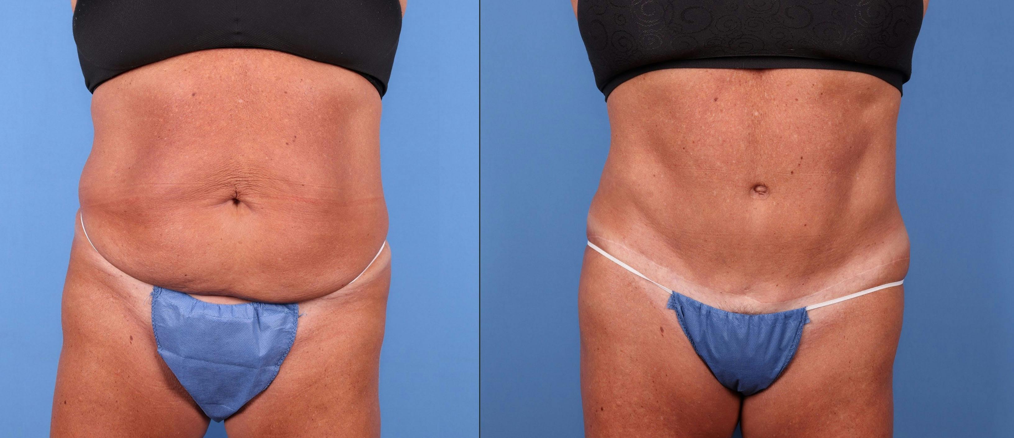 Tummy Tuck Before & After Gallery - Patient 148410950 - Image 1