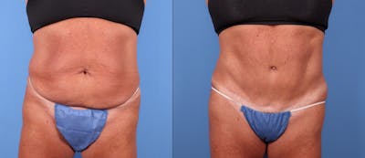 Tummy Tuck Before & After Gallery - Patient 148410950 - Image 1