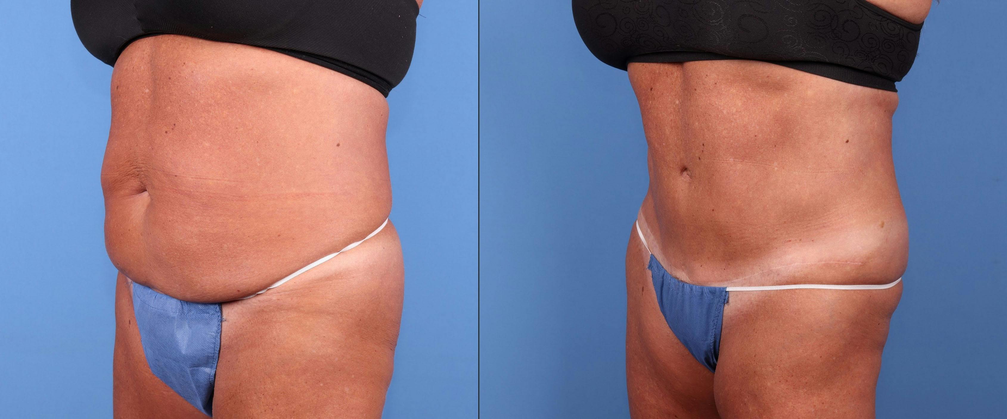 Abdomen Before & After Gallery - Patient 149385205 - Image 4