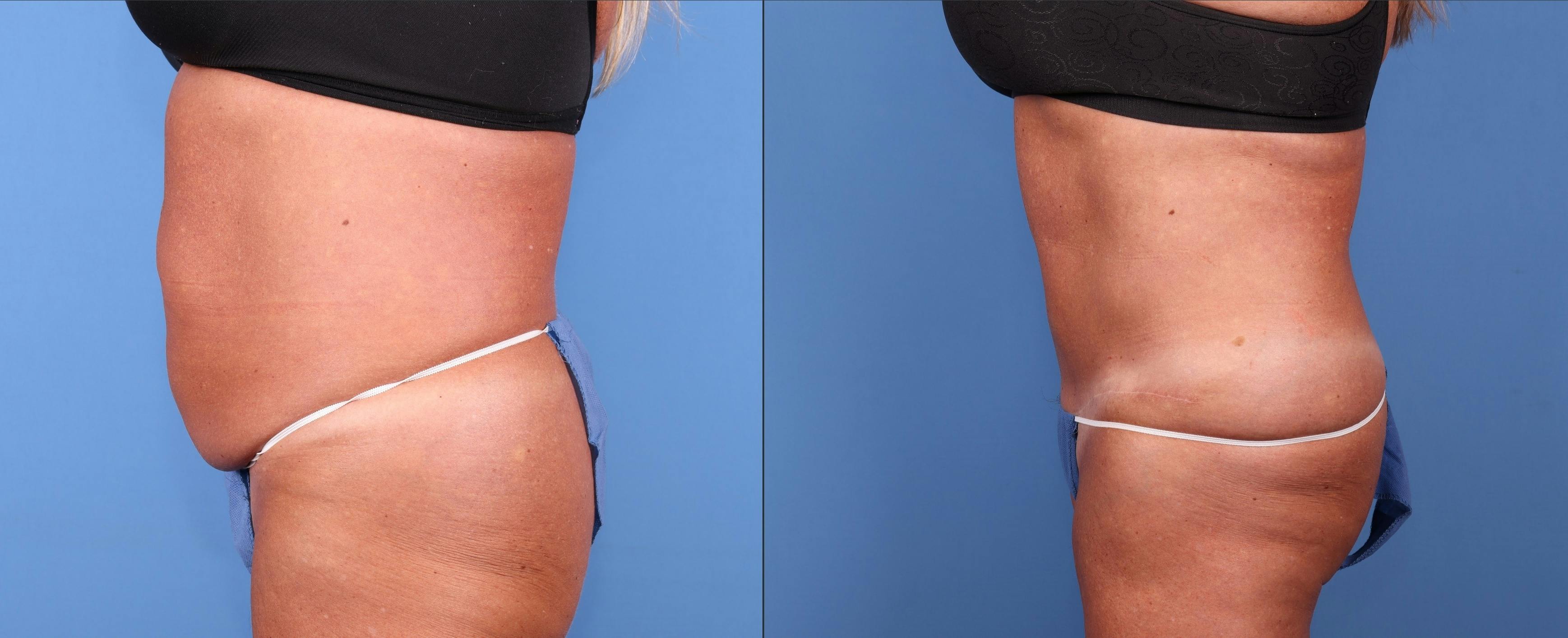 Tummy Tuck Before & After Gallery - Patient 148410950 - Image 5