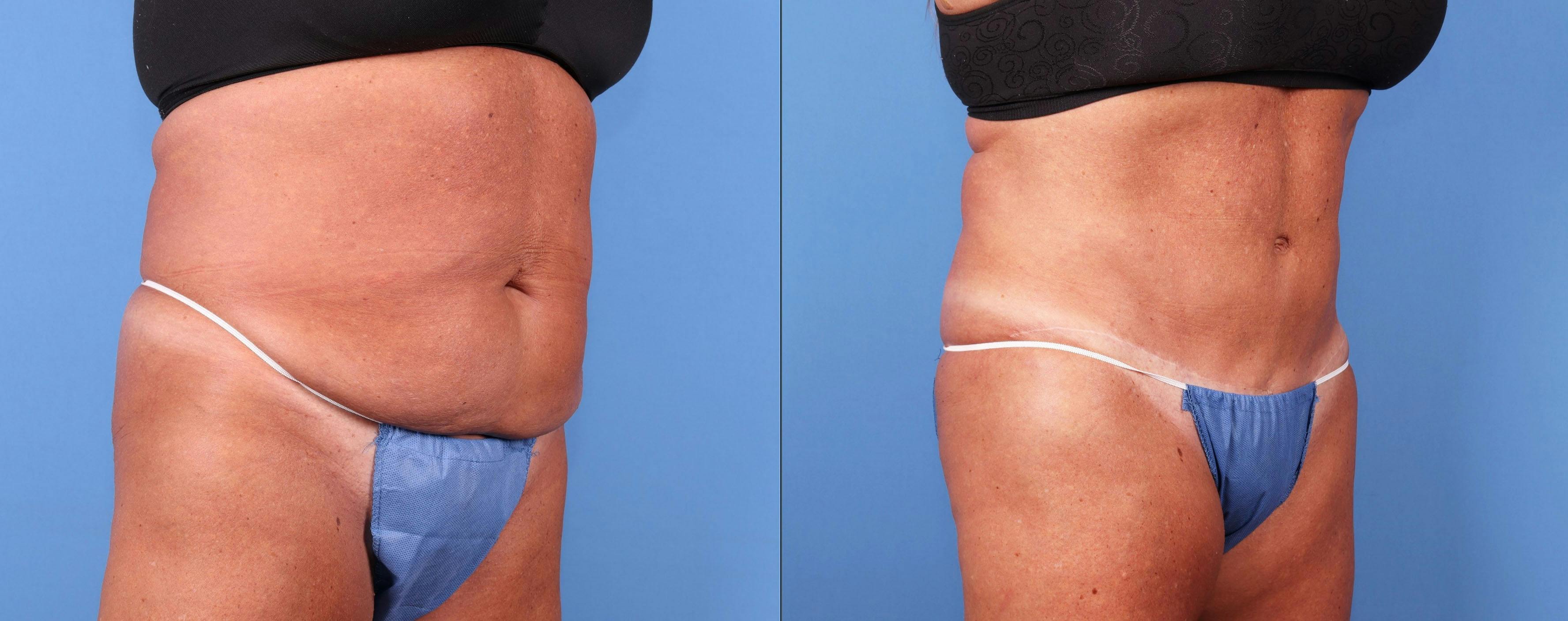 Abdomen Before & After Gallery - Patient 149385205 - Image 2