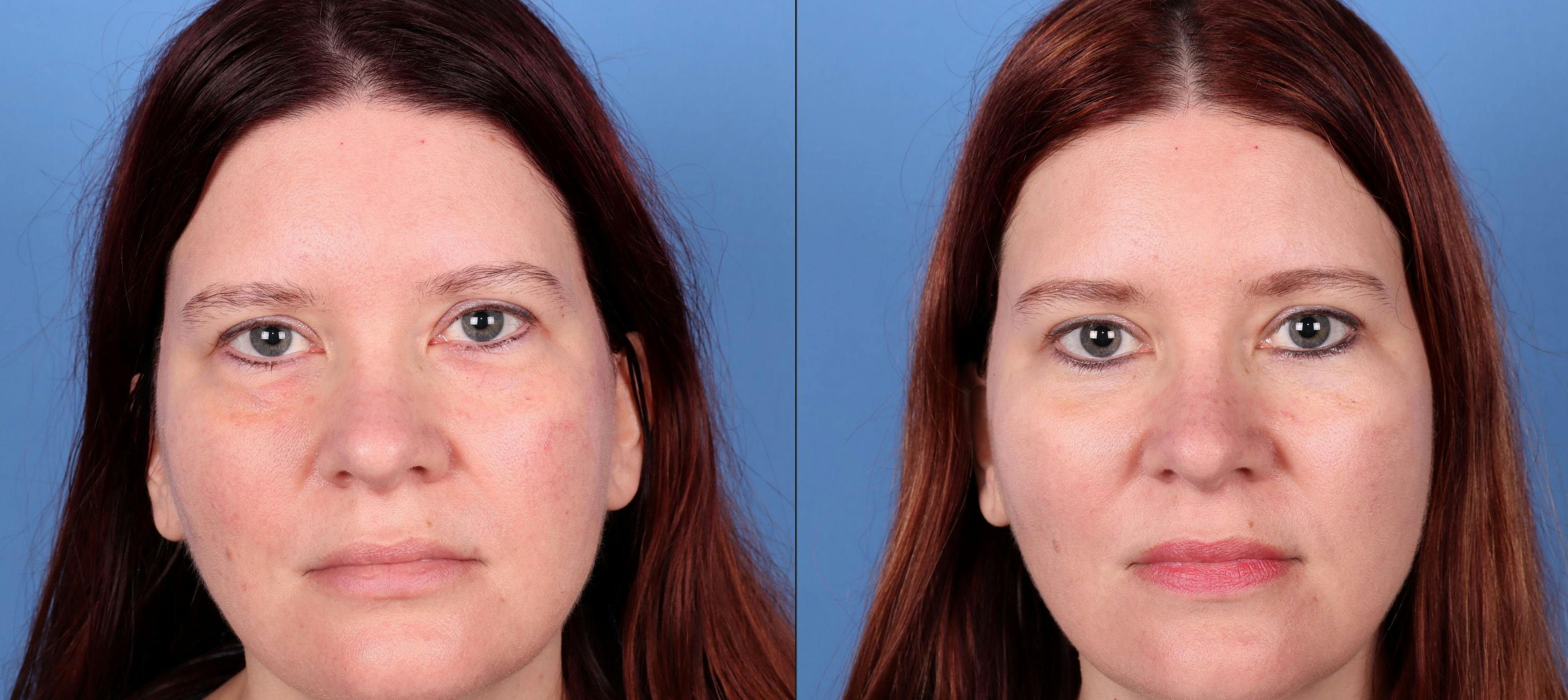 Eyelid Surgery (Upper & Lower Blepharoplasty) Before & After Gallery - Patient 277569 - Image 1